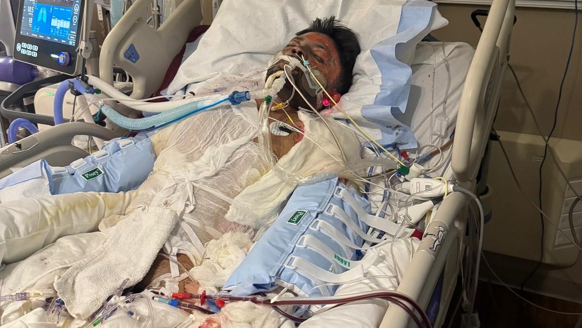 Help Mr. Preet Harsoda Recover from Severe Burns pinned link photo