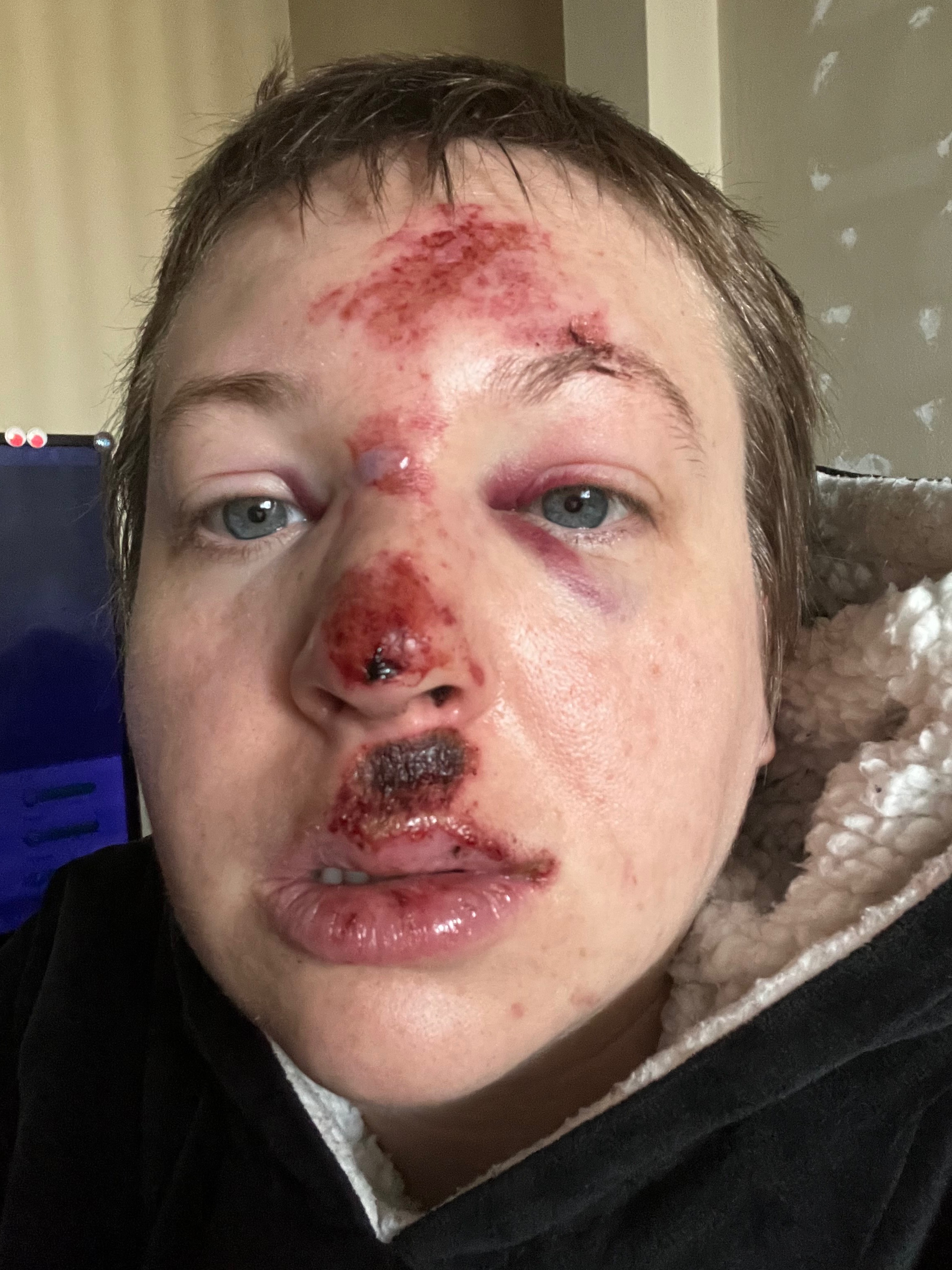 Recovering from a Scooter Accident campaign photo, 5 of 6