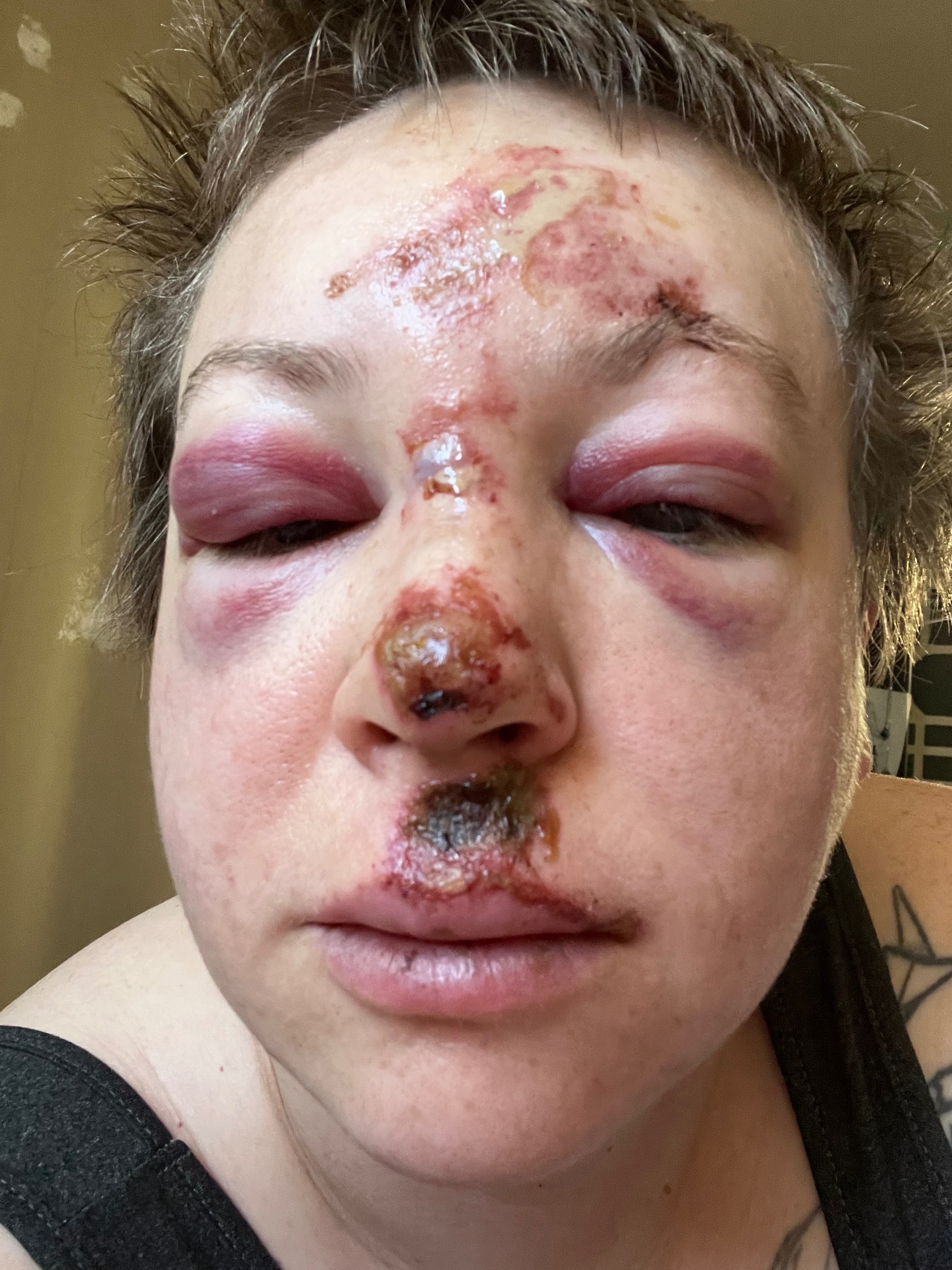 Recovering from a Scooter Accident campaign photo, 2 of 6