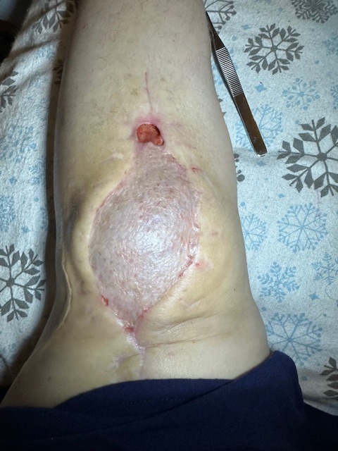 Help Tracie Recover from Severe Knee Infection campaign photo, 5 of 6