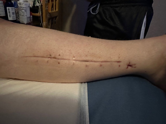 Help Tracie Recover from Severe Knee Infection campaign photo, 2 of 6
