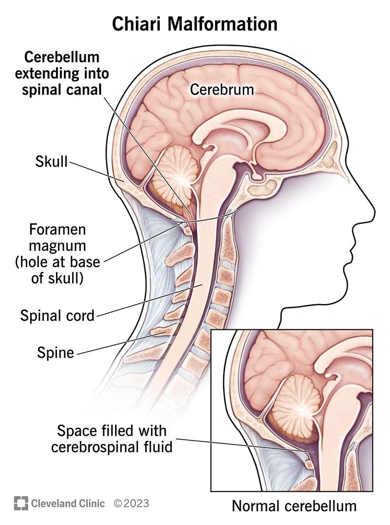 Help Me Through My Third Chiari Decompression Surgery campaign photo, 5 of 6
