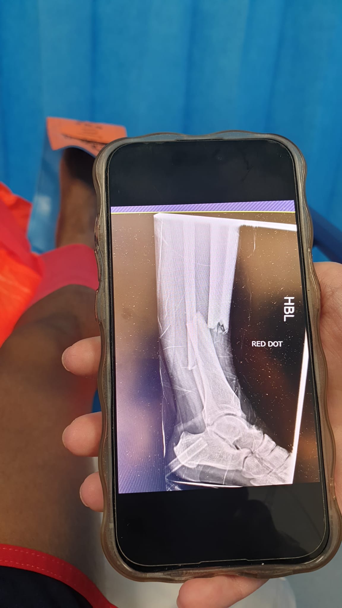 Help Everton Belgrave after breaking his leg at football. campaign photo, 2 of 3
