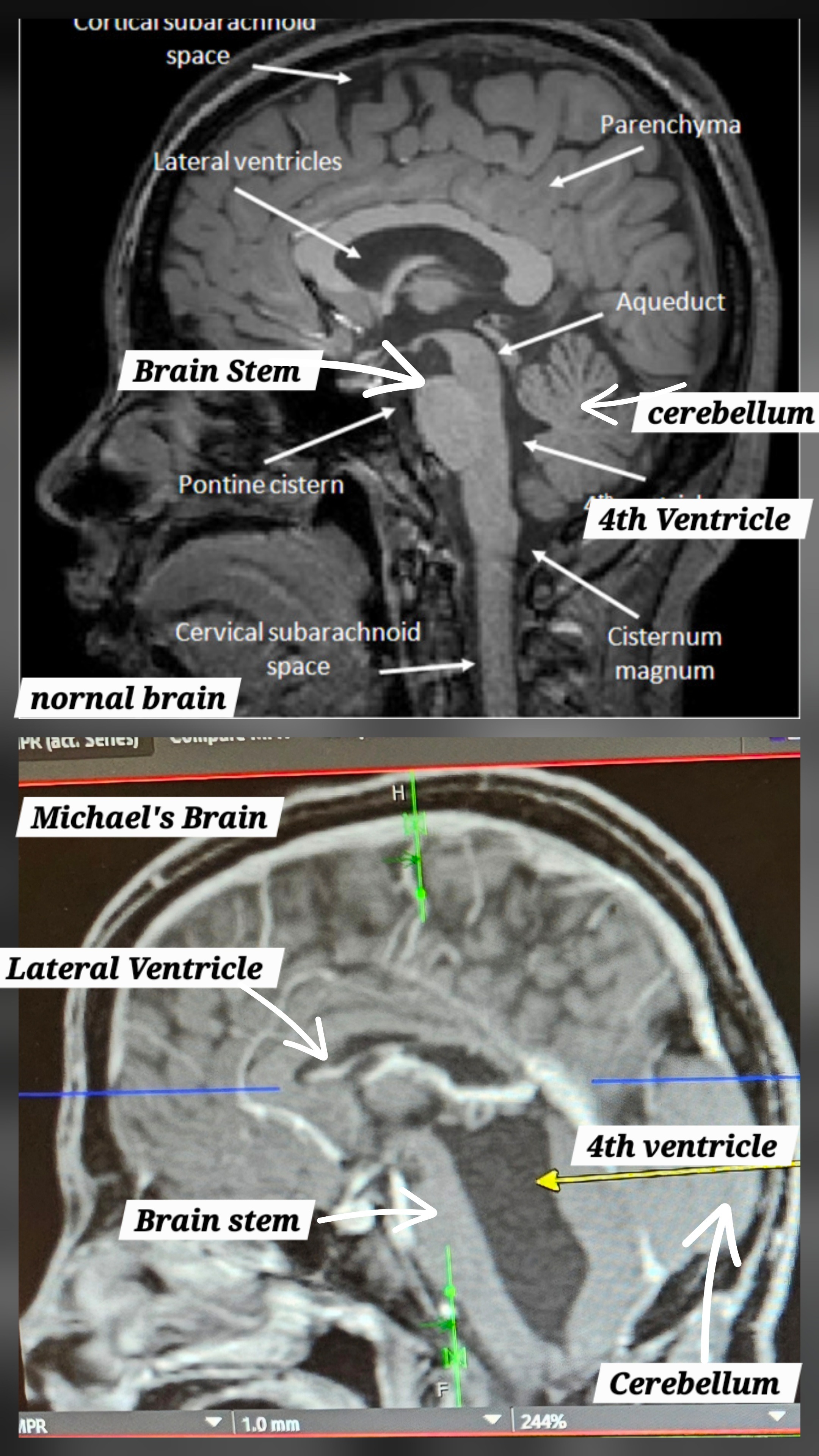 Support Michael's Crucial Neurosurgery Journey campaign photo, 6 of 7