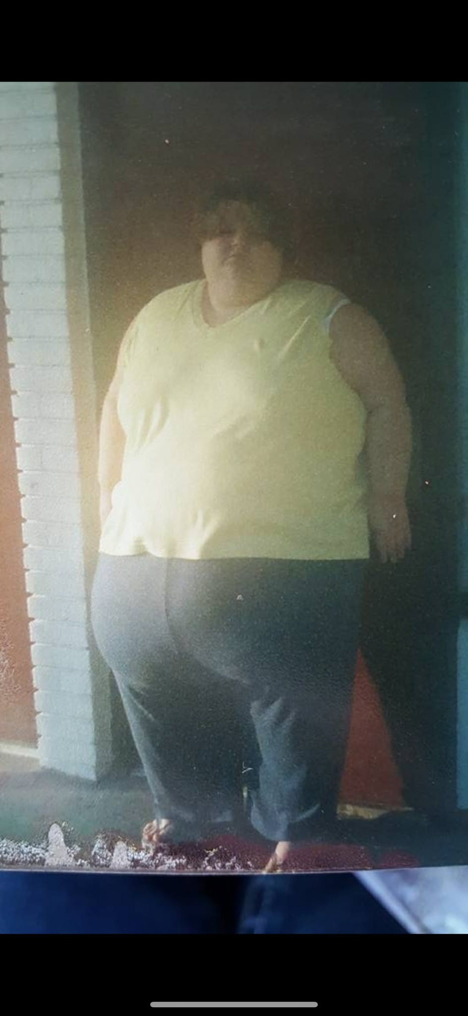 Support Christina's Journey for Skin Removal campaign photo, 2 of 6