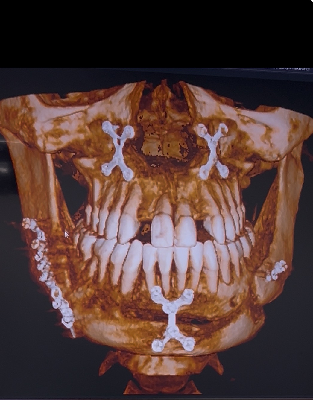 Botched Jaw Surgery revision campaign photo, 5 of 6
