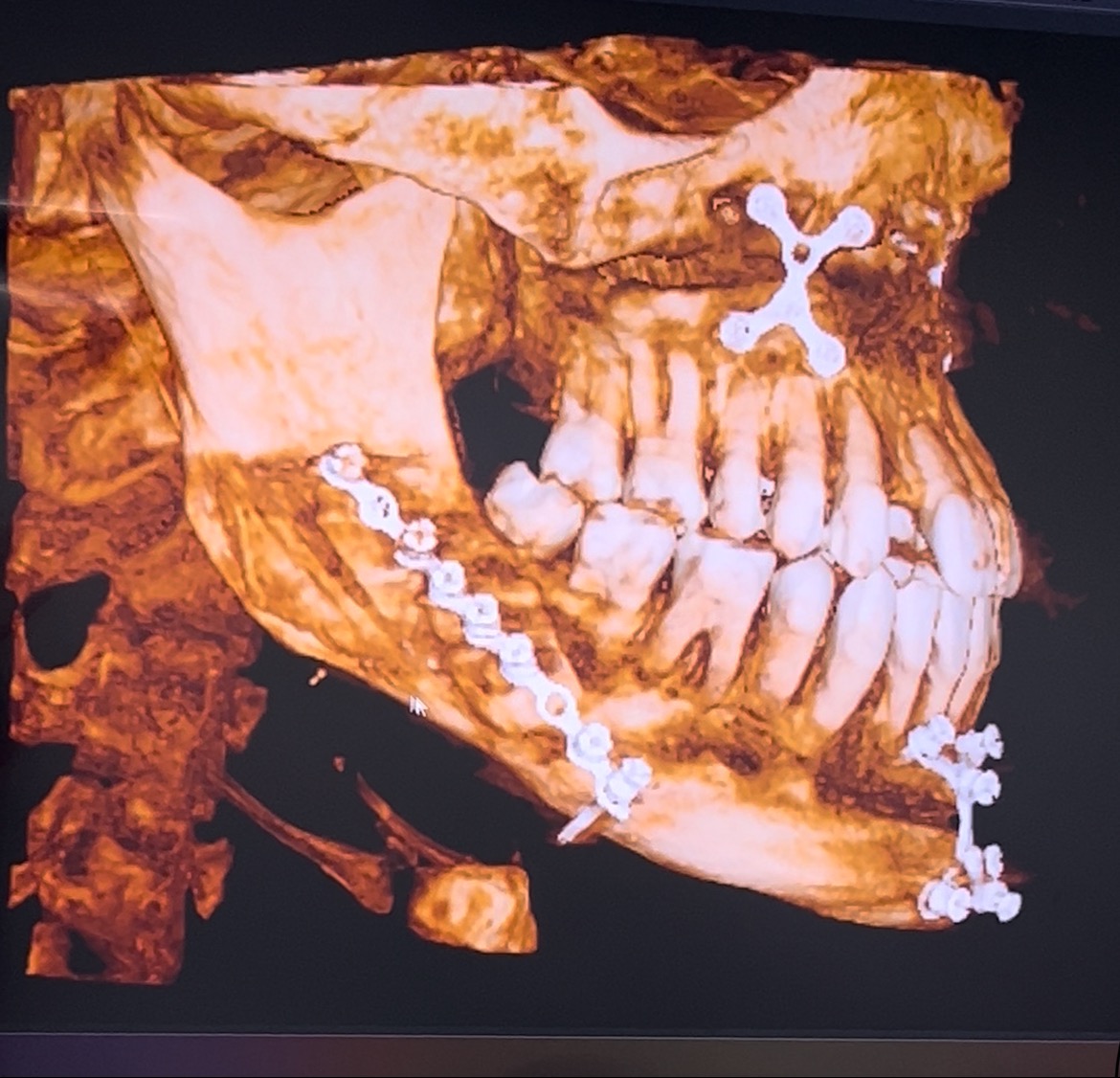 Botched Jaw Surgery revision campaign photo, 2 of 6
