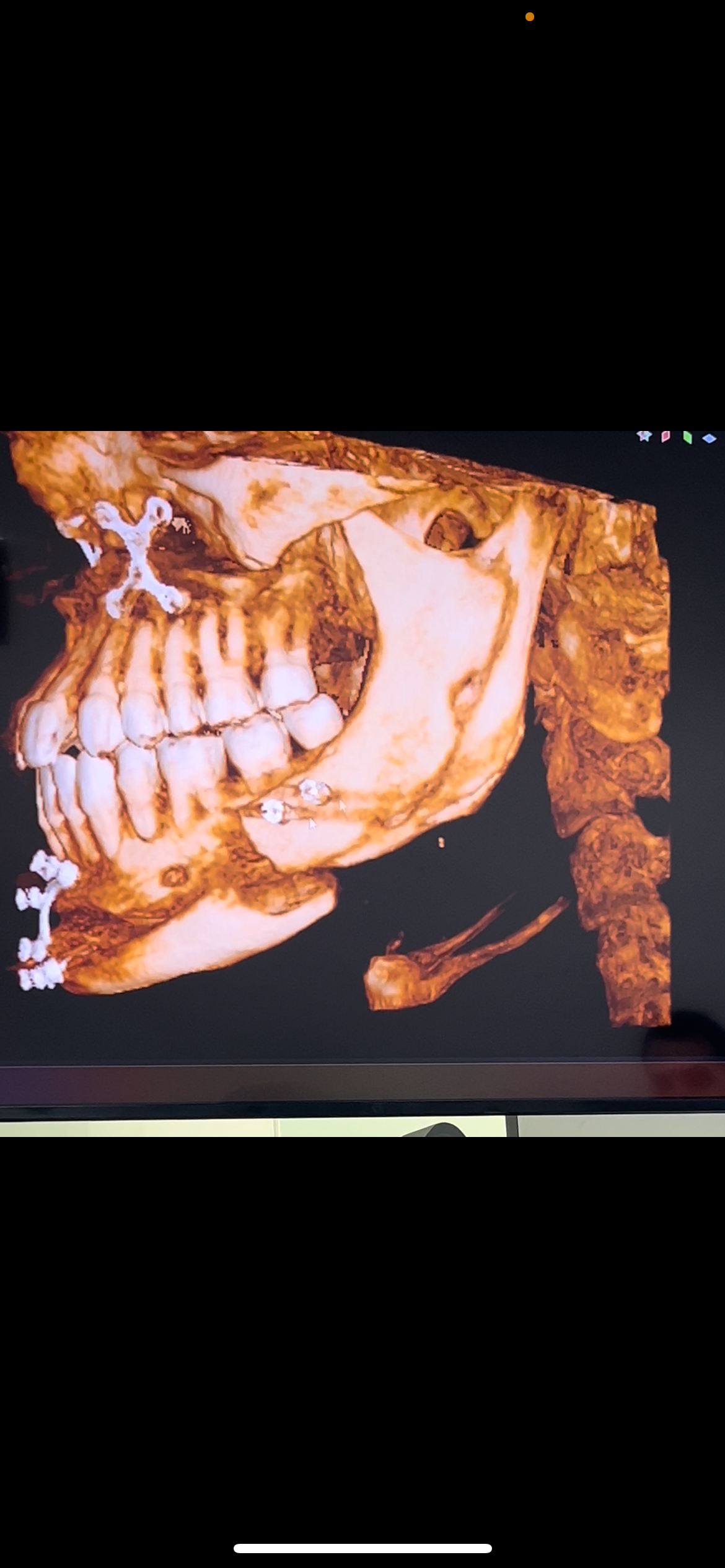 Botched Jaw Surgery revision campaign photo, 4 of 6