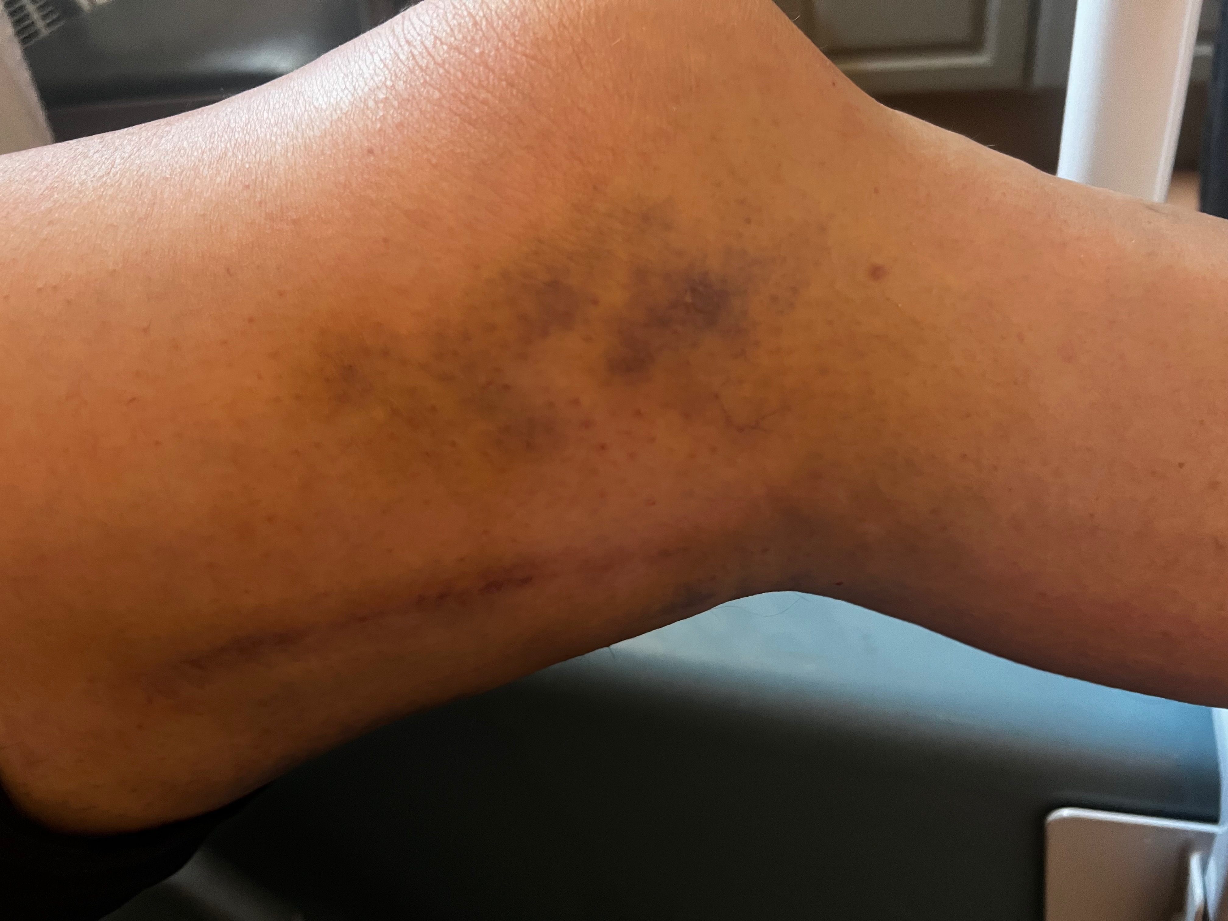 Deb Broke Her Kneecap & Wrist Doing a Kind Favor campaign photo, 2 of 7