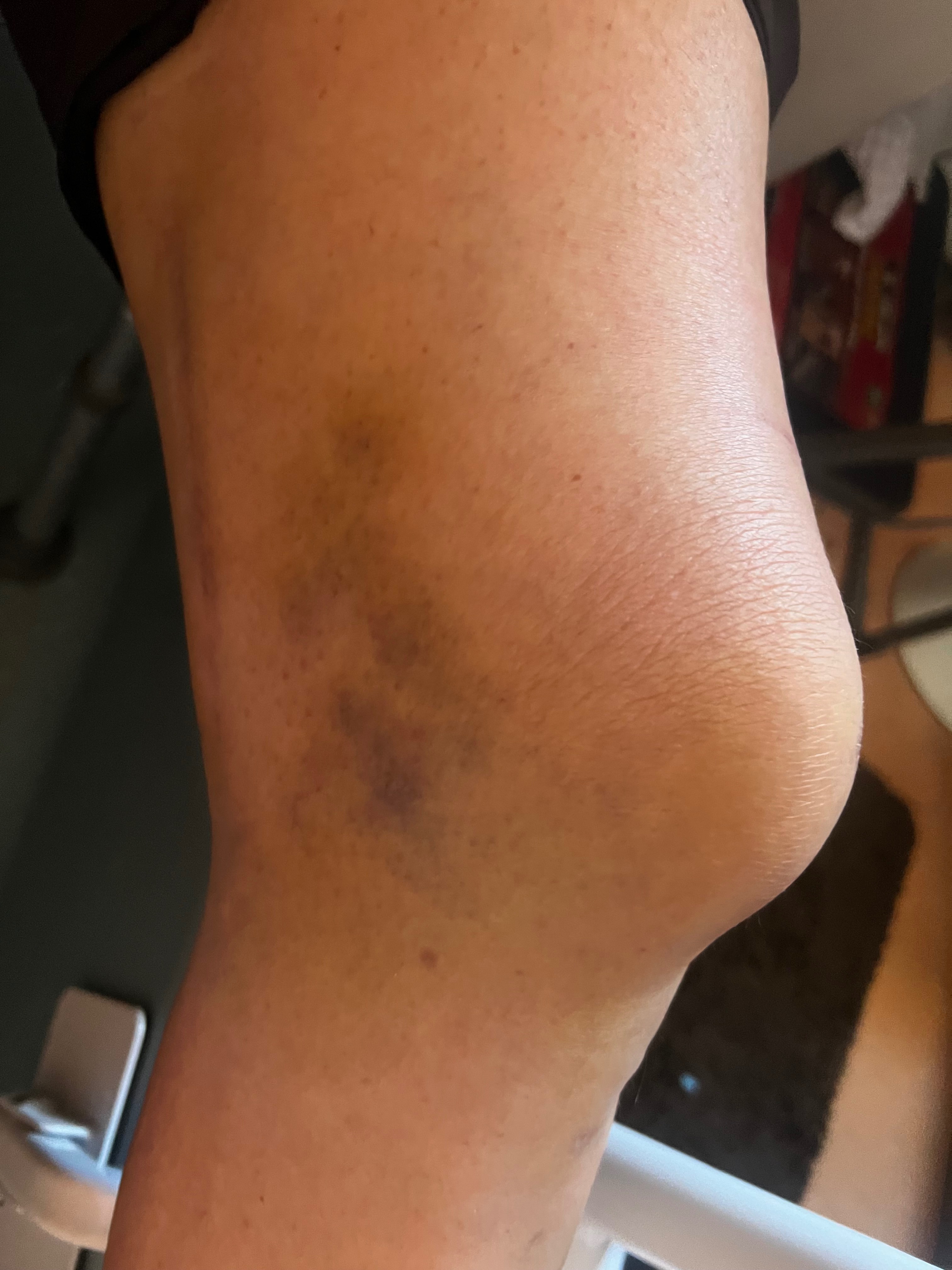 Deb Broke Her Kneecap & Wrist Doing a Kind Favor campaign photo, 6 of 7