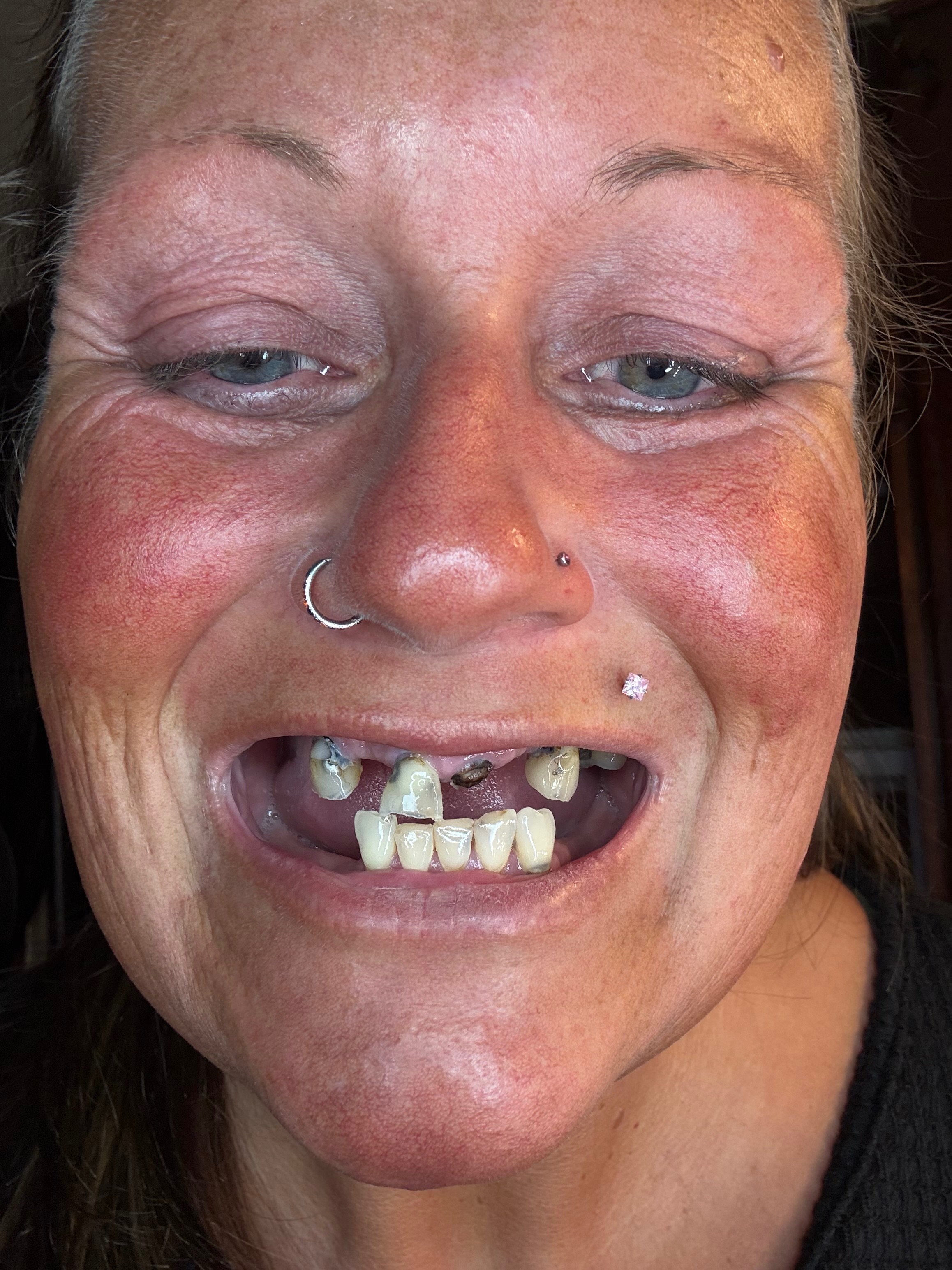 Restore Kristy's Smile and help her get out of pain campaign photo, 5 of 6