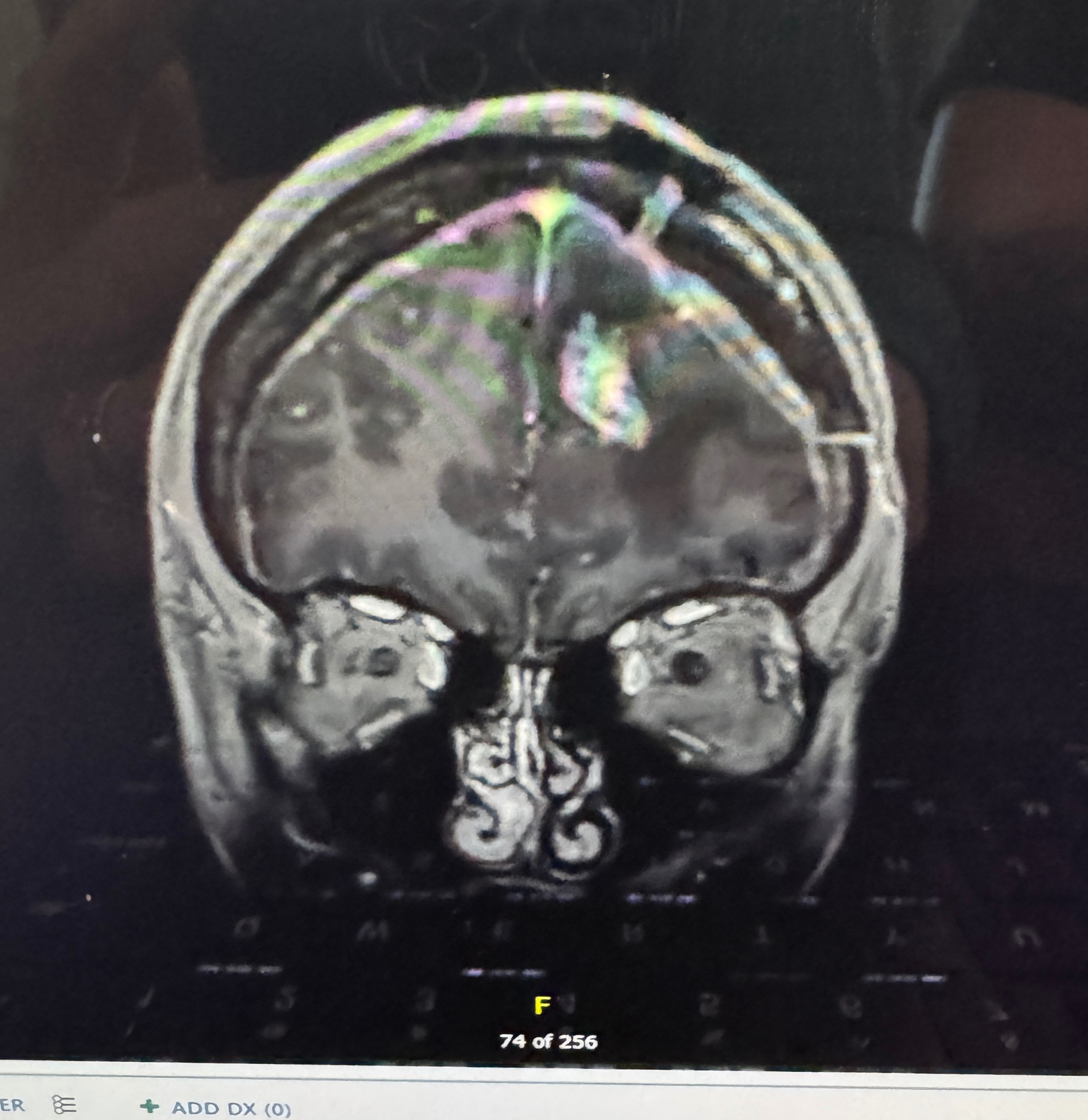Funds Needed for Brain Cancer Surgery & Travel campaign photo, 6 of 7
