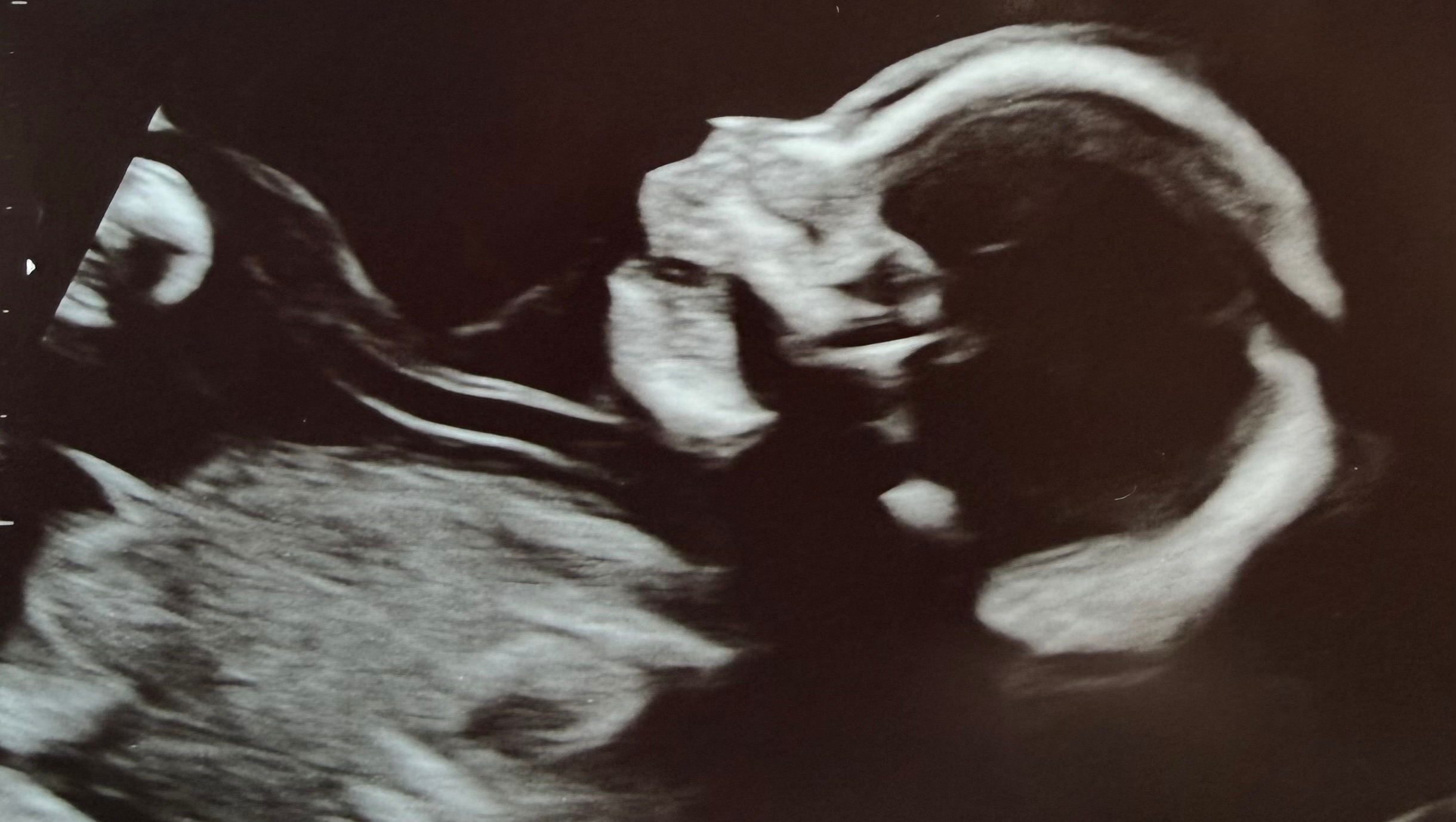 Pregnant RN facing sudden disability and financial crisis photo