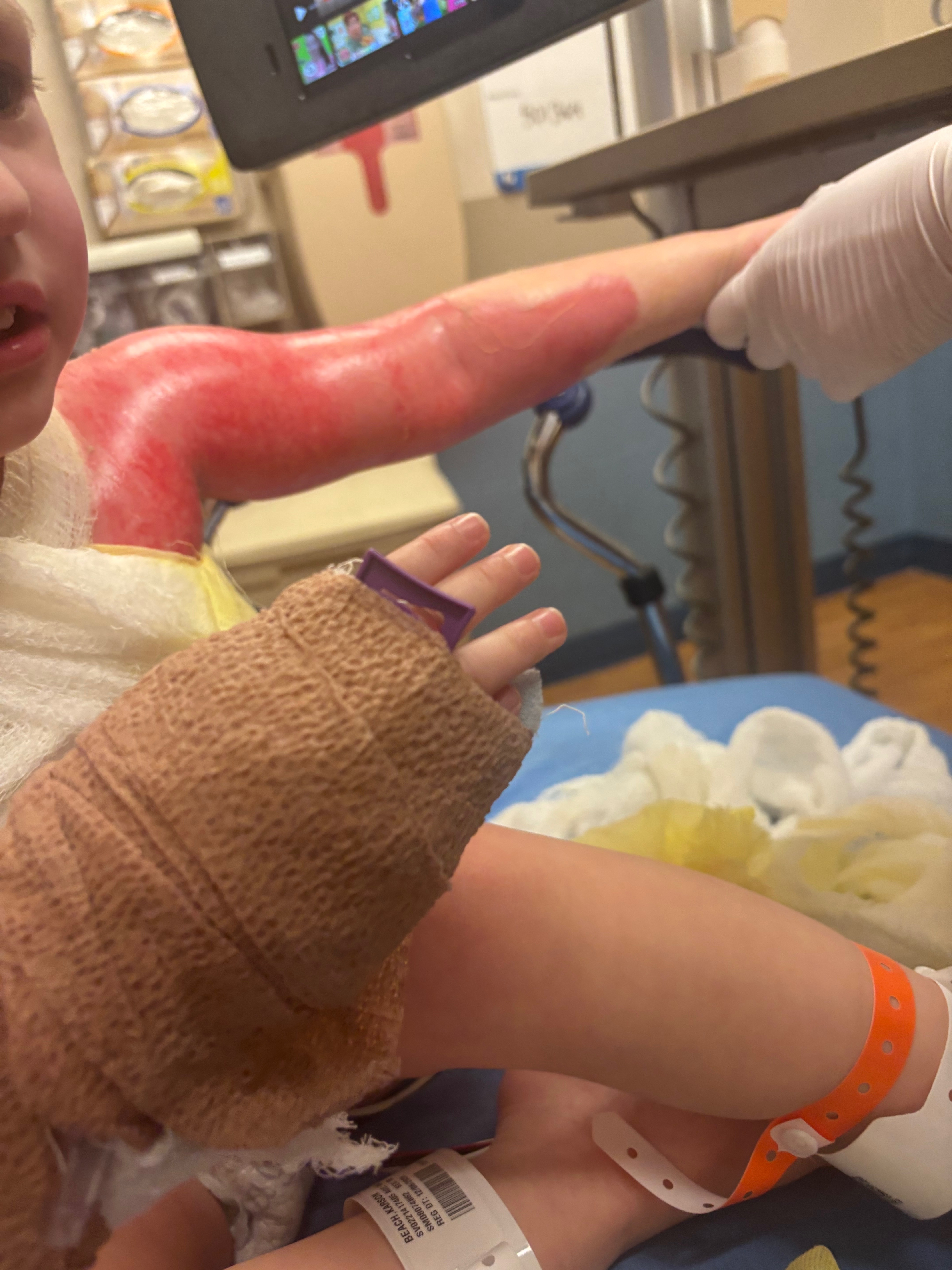 Help Karson Heal After Severe Burns campaign photo, 4 of 8