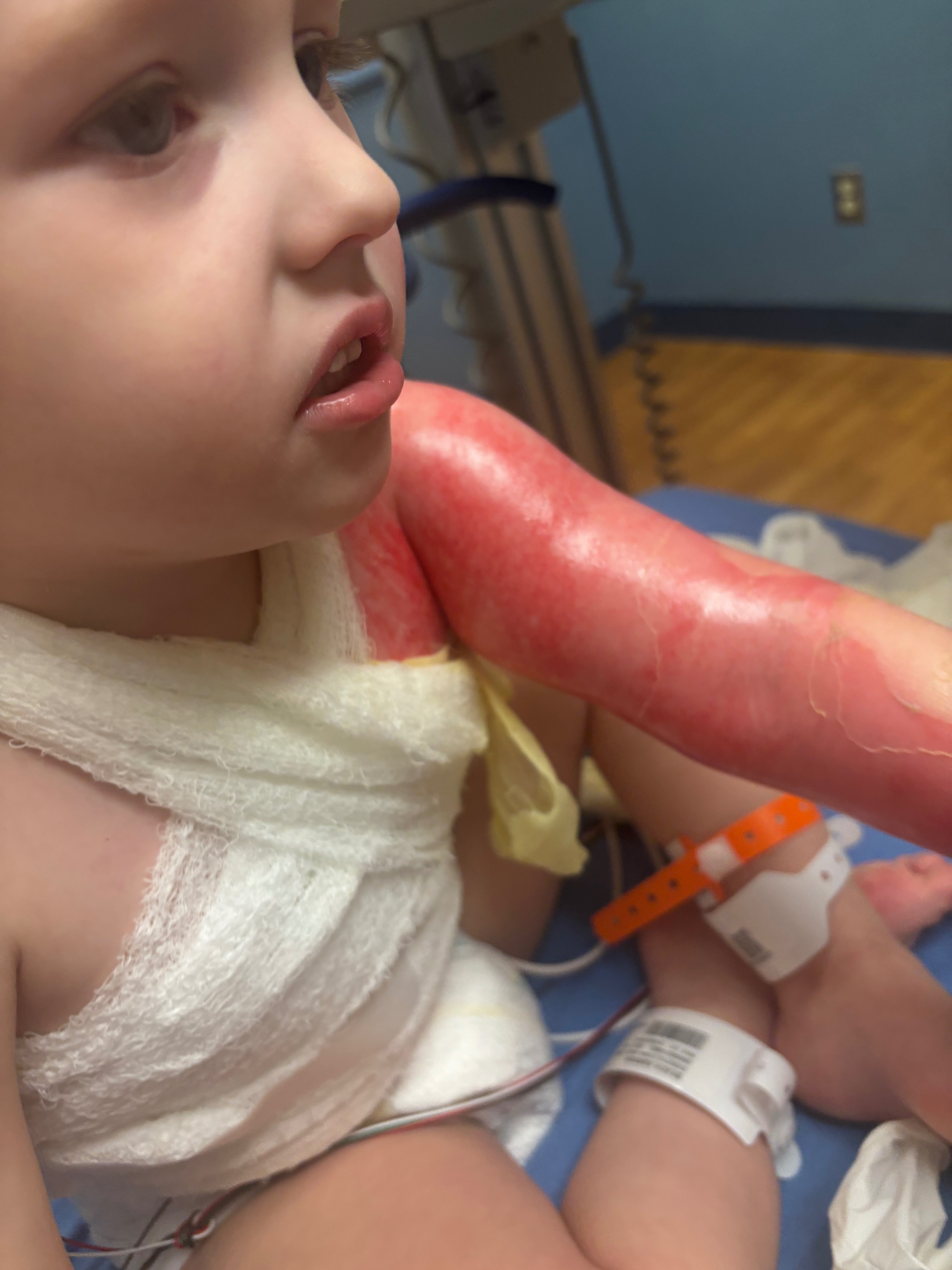 Help Karson Heal After Severe Burns campaign photo, 5 of 8