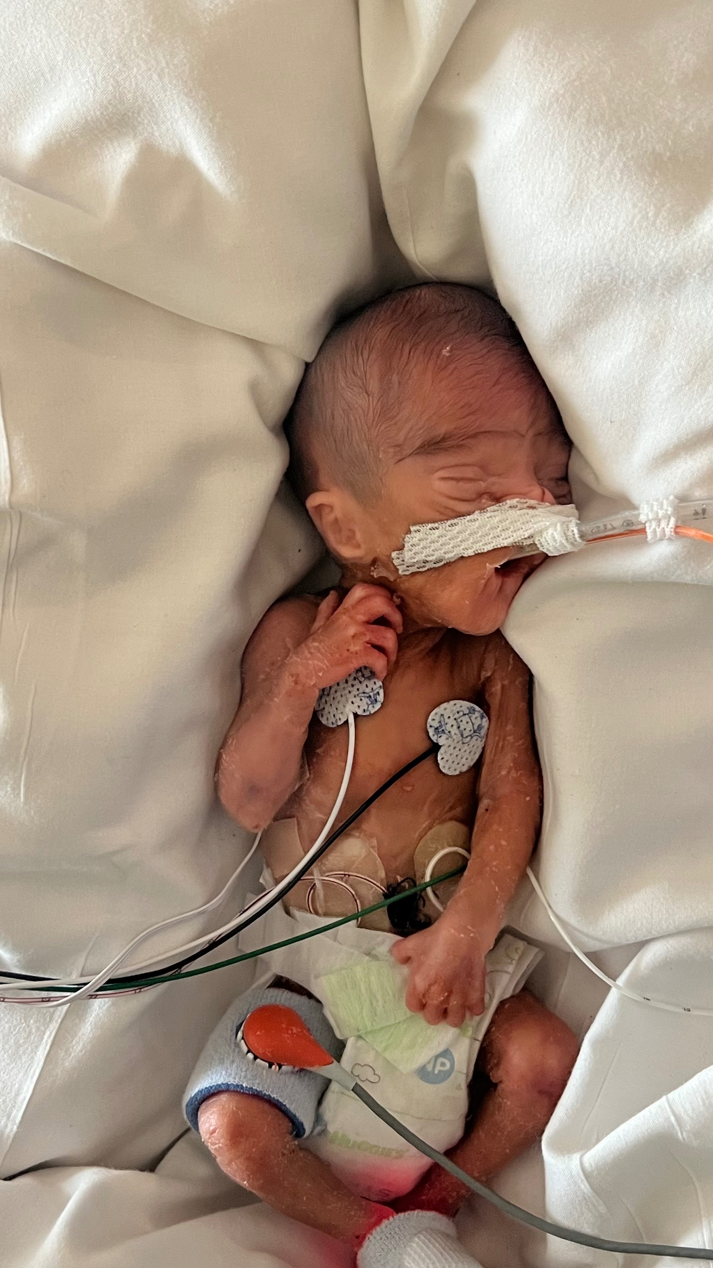 Support Baby Finch’s NICU Journey campaign photo, 2 of 8