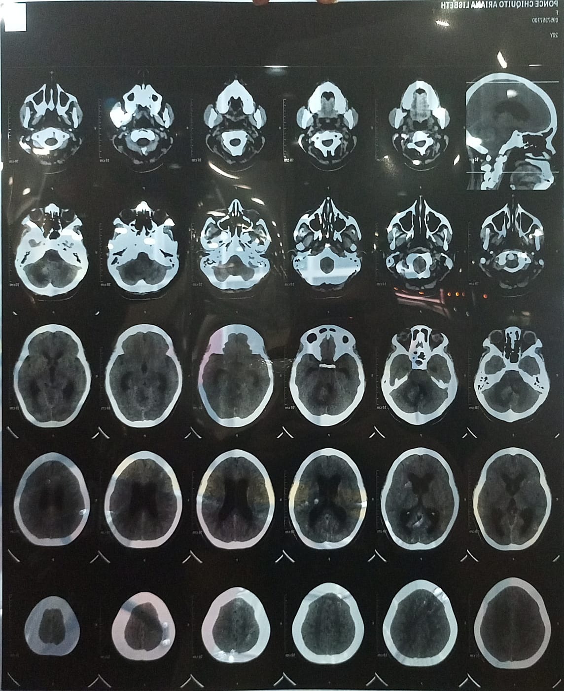Cirugía urgente para Ariana , Tumor cerebral -Fosa Posterior campaign photo, 2 of 8