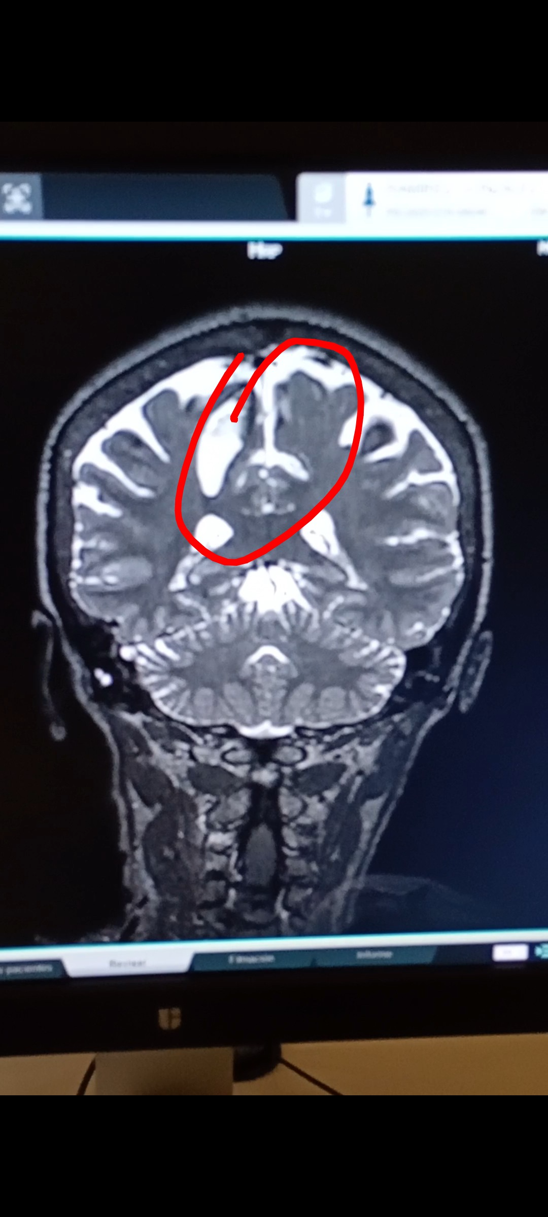 Foto de la recaudación de fondos Mi operación para quitar el tumor cerebral !!!!, 6 de 7