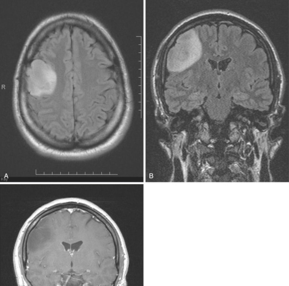 Restore Vision for a 5 year old Girl with a Brain Tumour campaign photo, 2 of 5