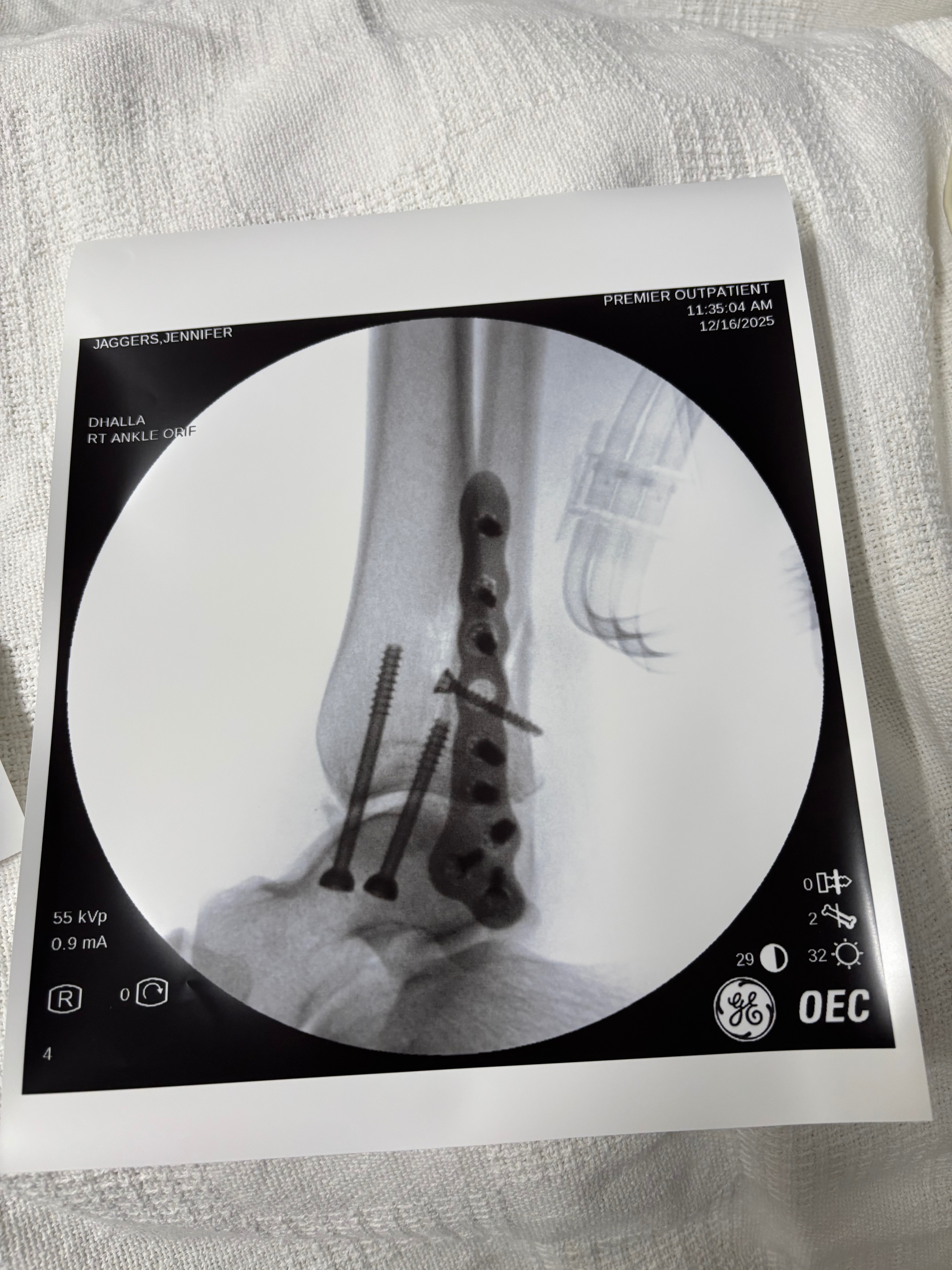 Urgent Surgery Help for My Broken Ankle campaign photo, 5 of 6
