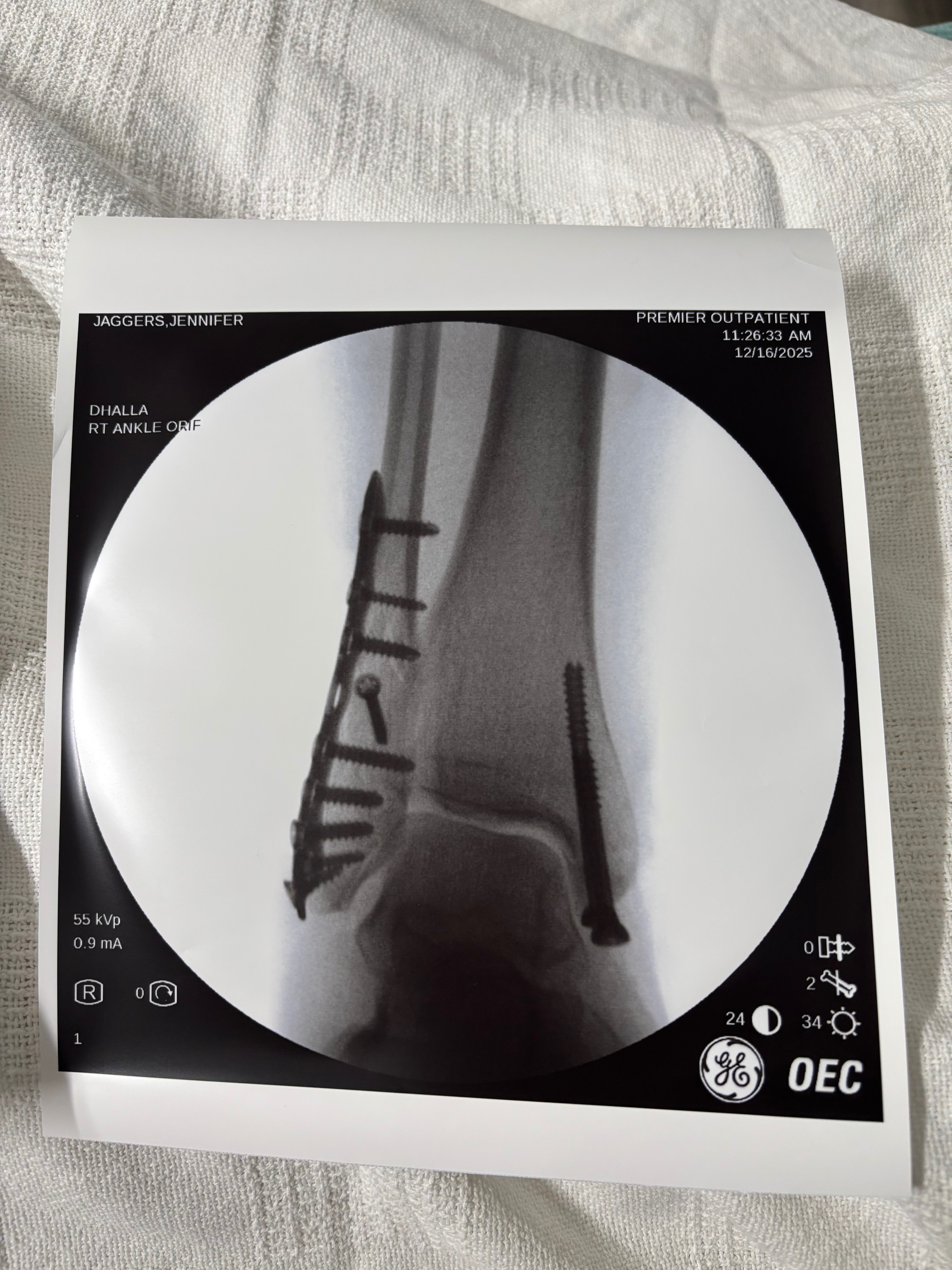 Urgent Surgery Help for My Broken Ankle campaign photo, 2 of 6