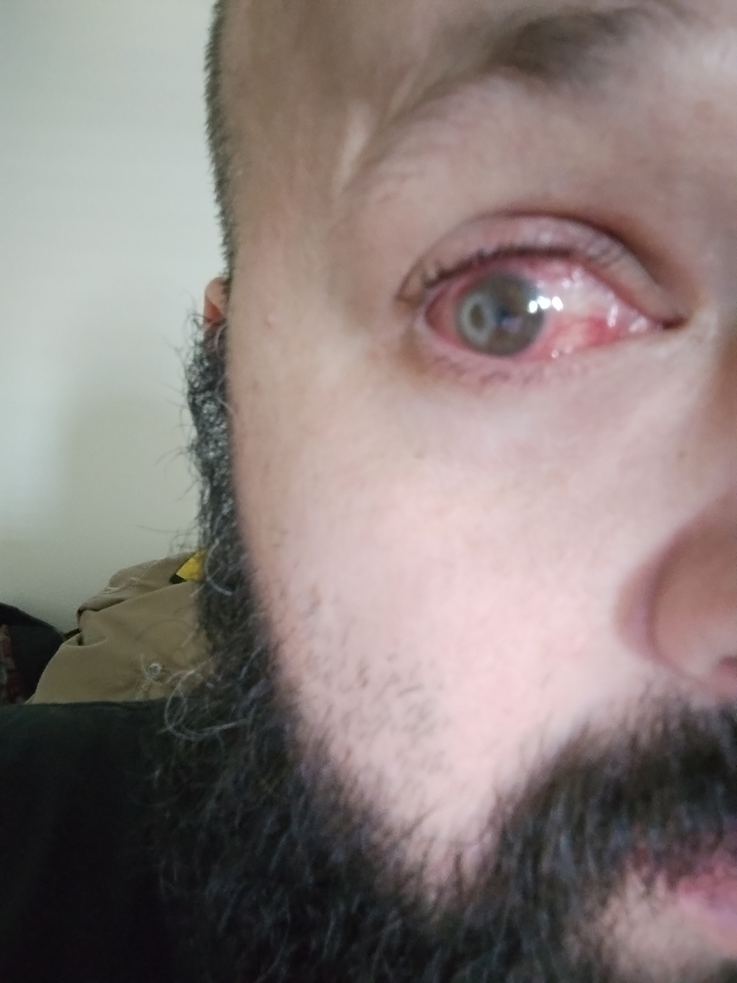 how much is a foger vape battery Woman Puts E-Cig Liquid in Her Eye After Mistaking It for Eyedrops main image 1