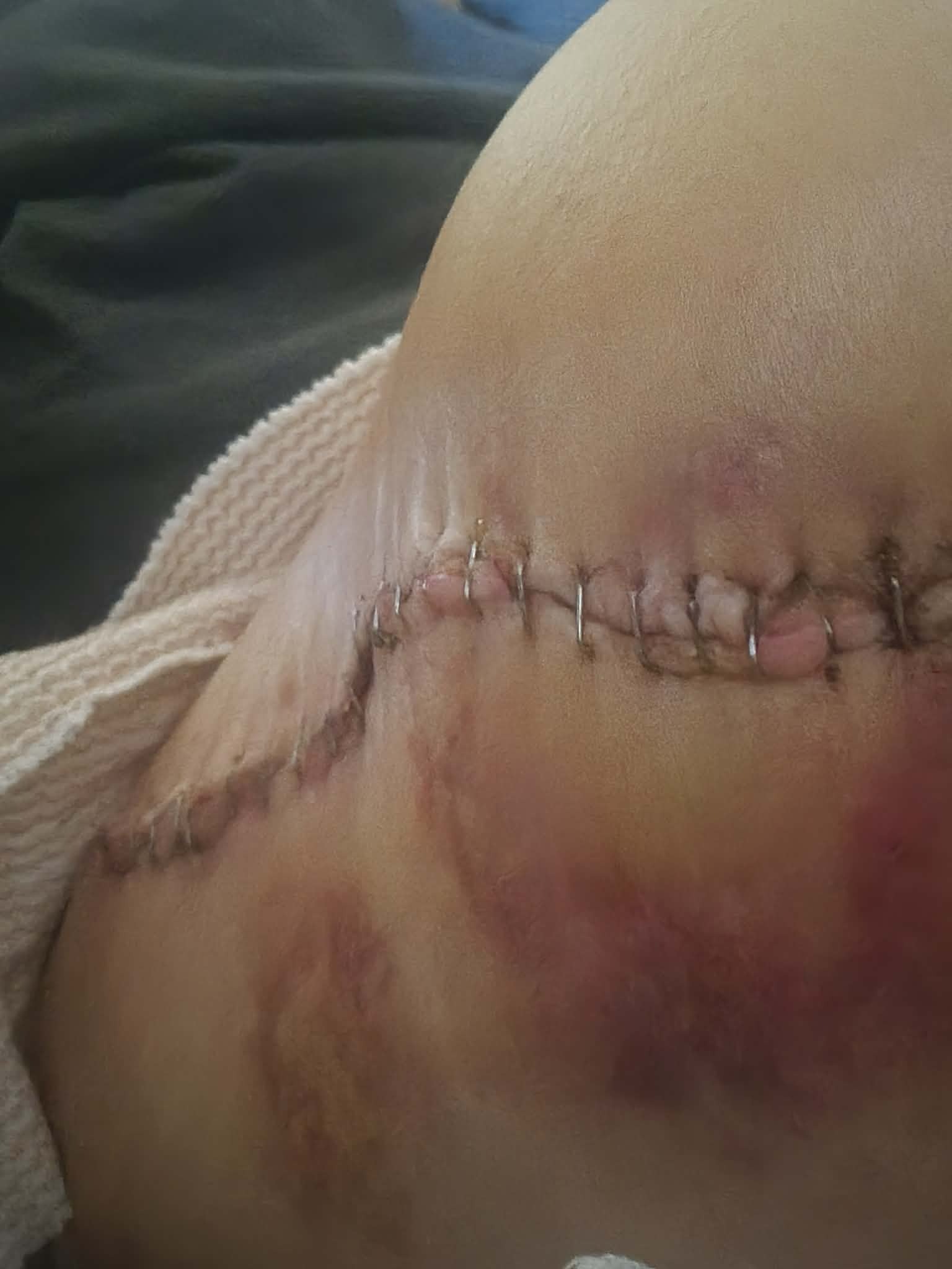 Help Angie Walk Again with Vital Therapy campaign photo, 6 of 8