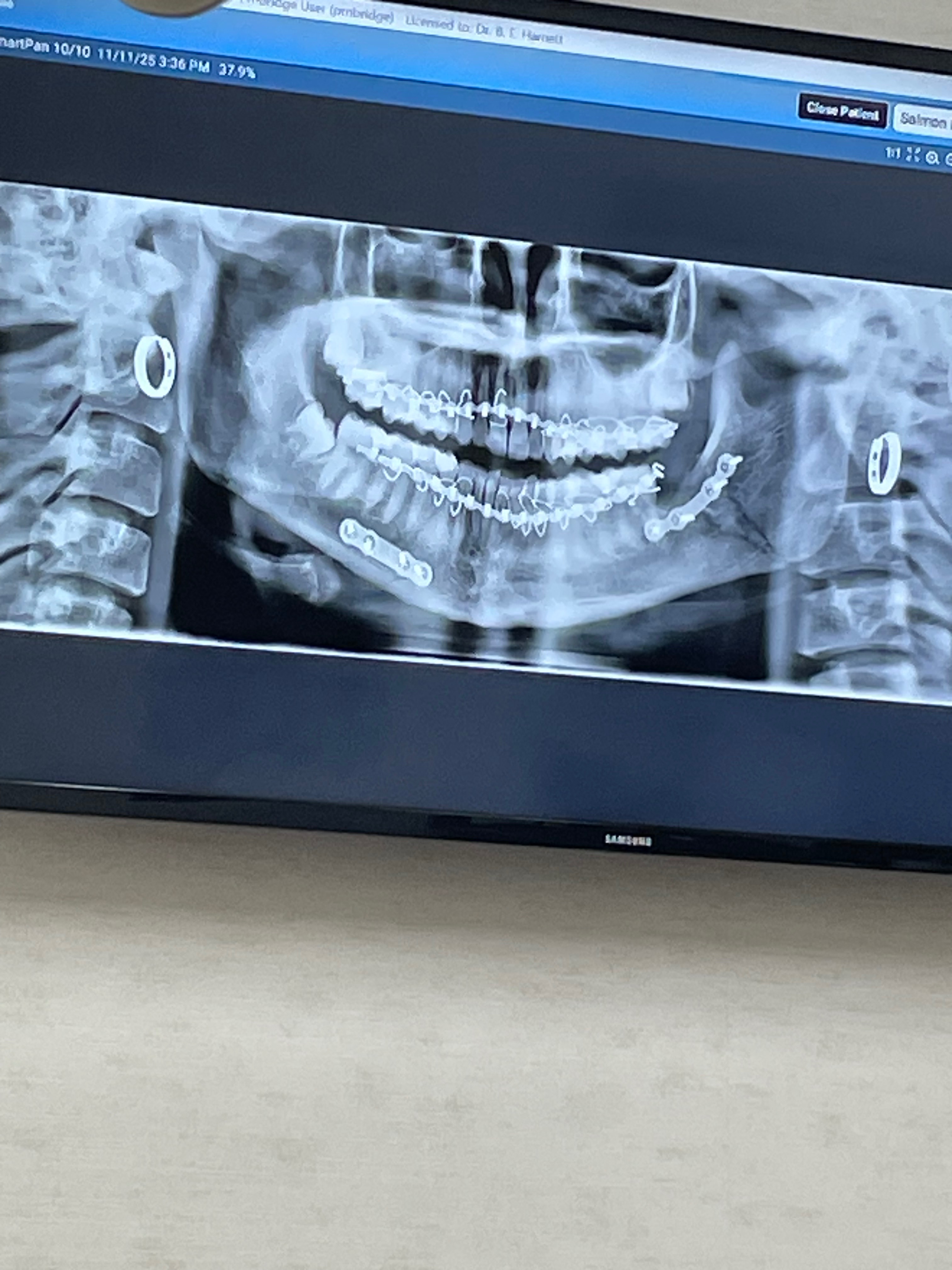Jaw injury requiring surgery for medical brace campaign photo, 2 of 5