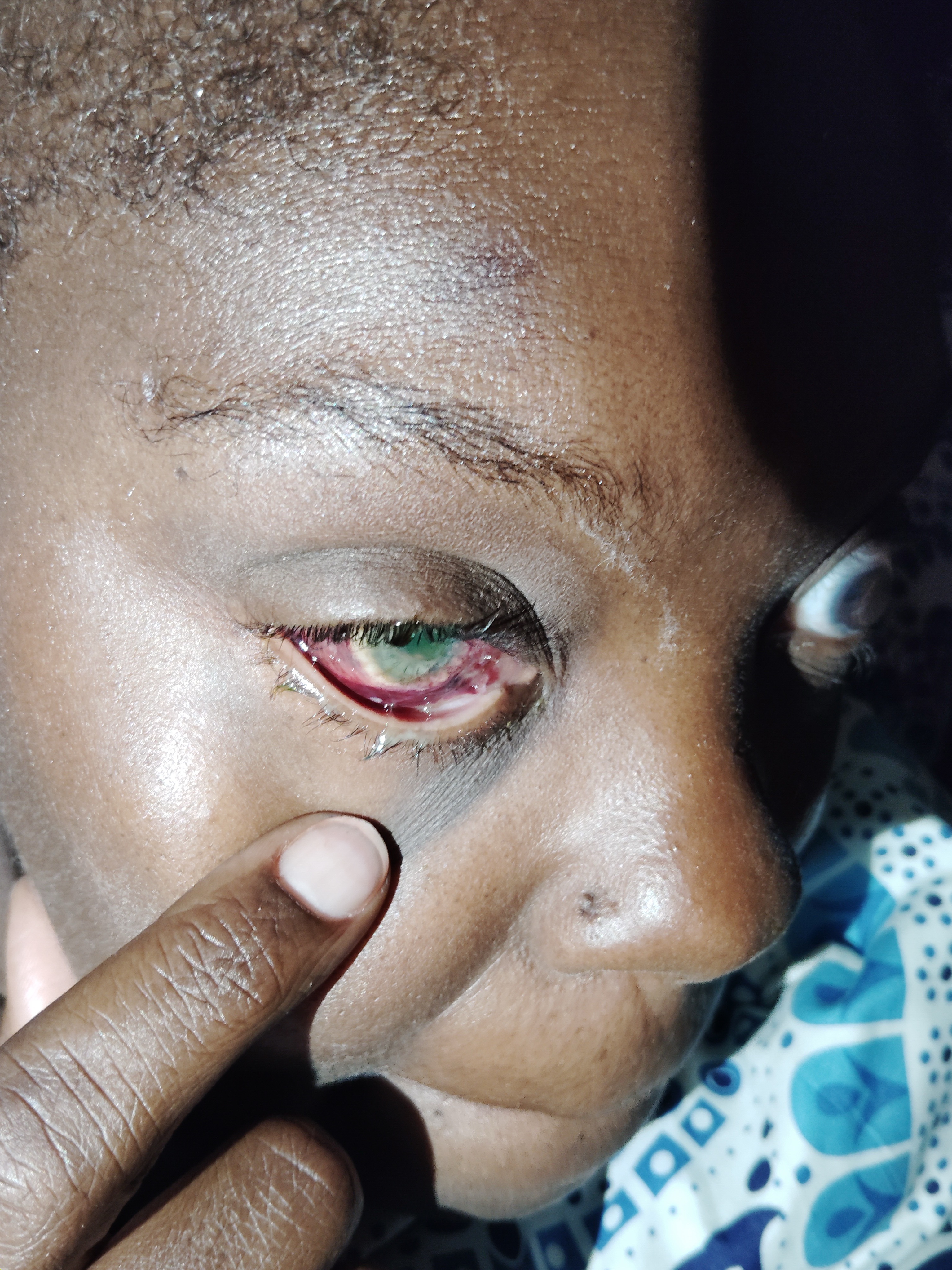 Help Patricia Get Her Prosthetic Eye campaign photo, 5 of 6