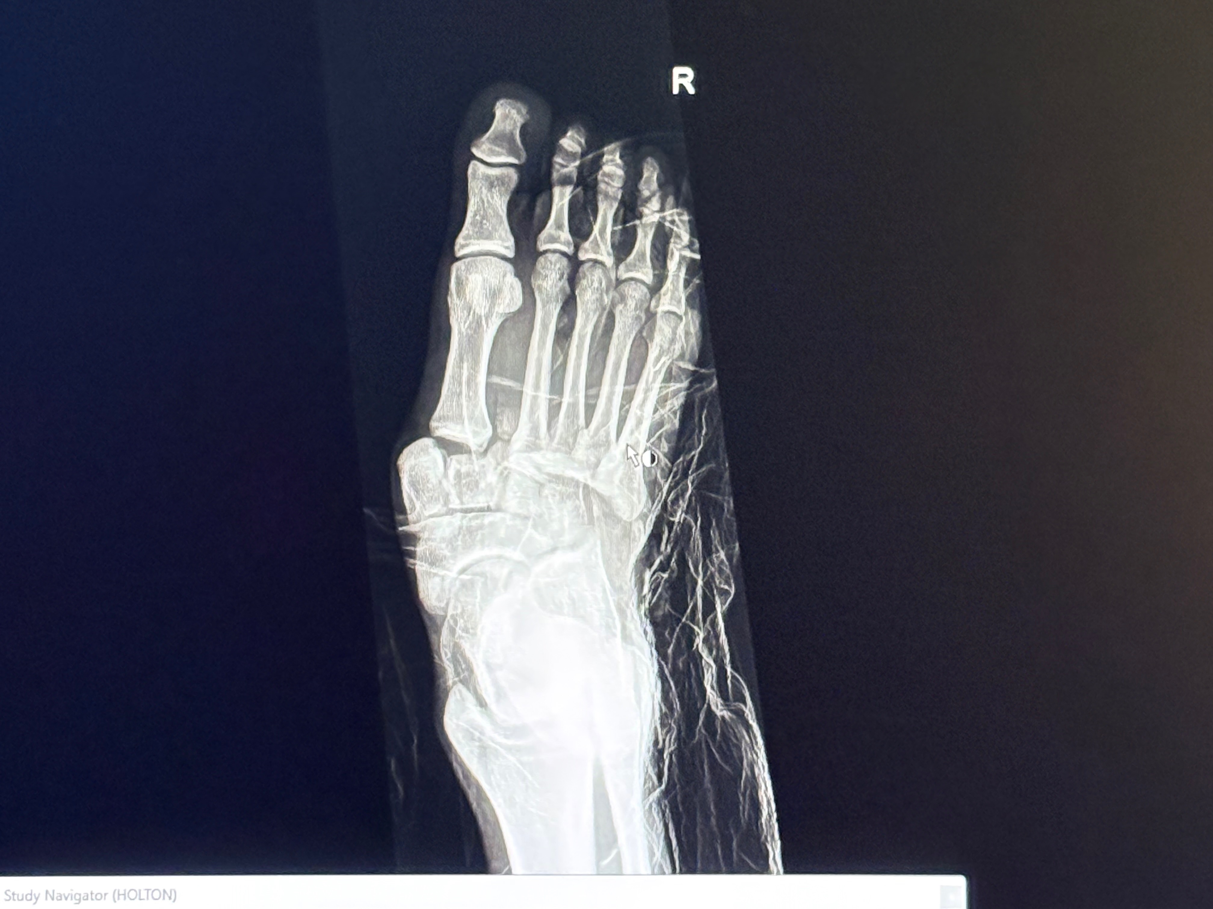 Help 22 Year Old Will Holton Afford Foot Surgery campaign photo, 7 of 8