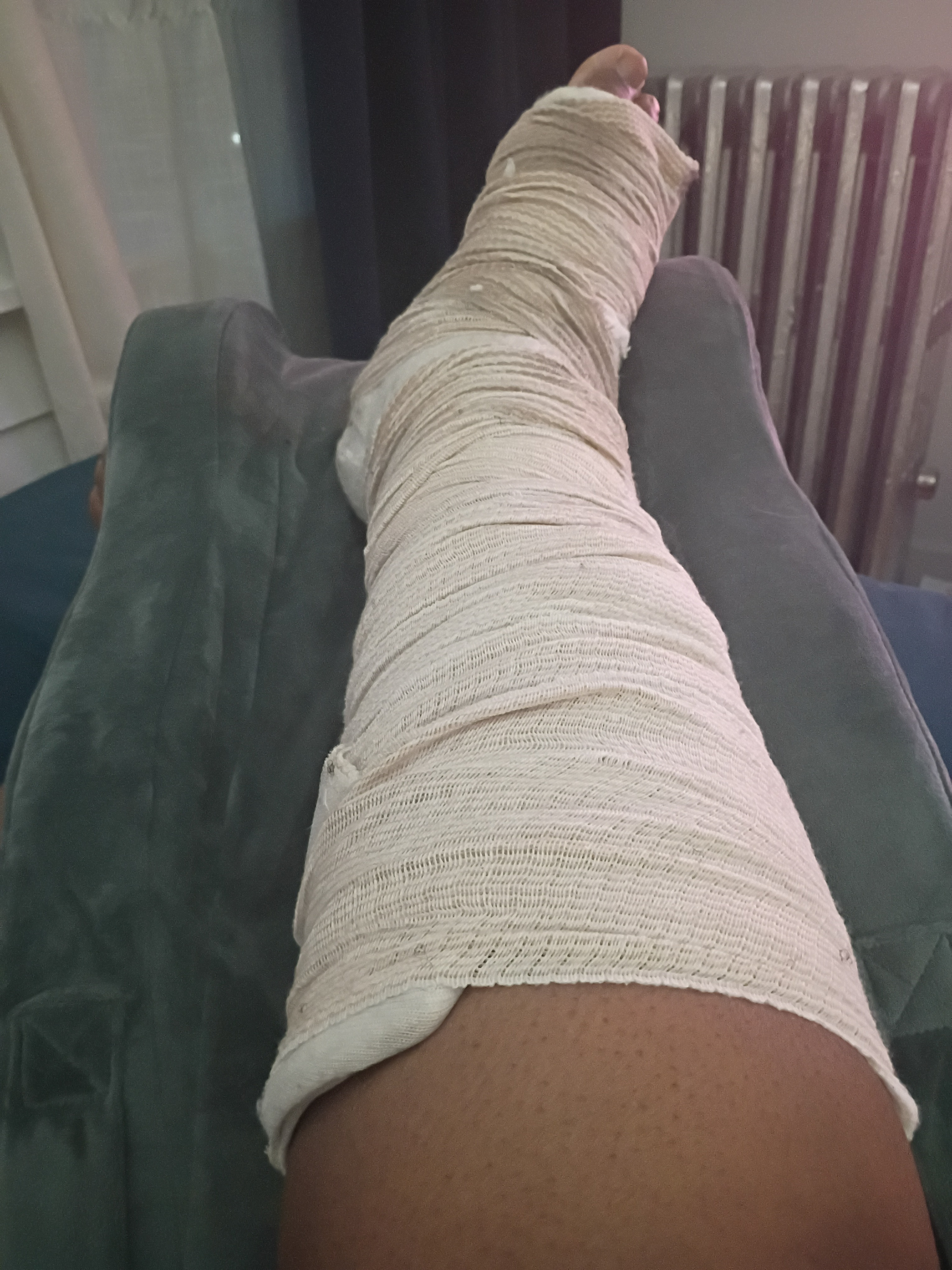 Help Me Recover from Ankle Surgery campaign photo, 2 of 4