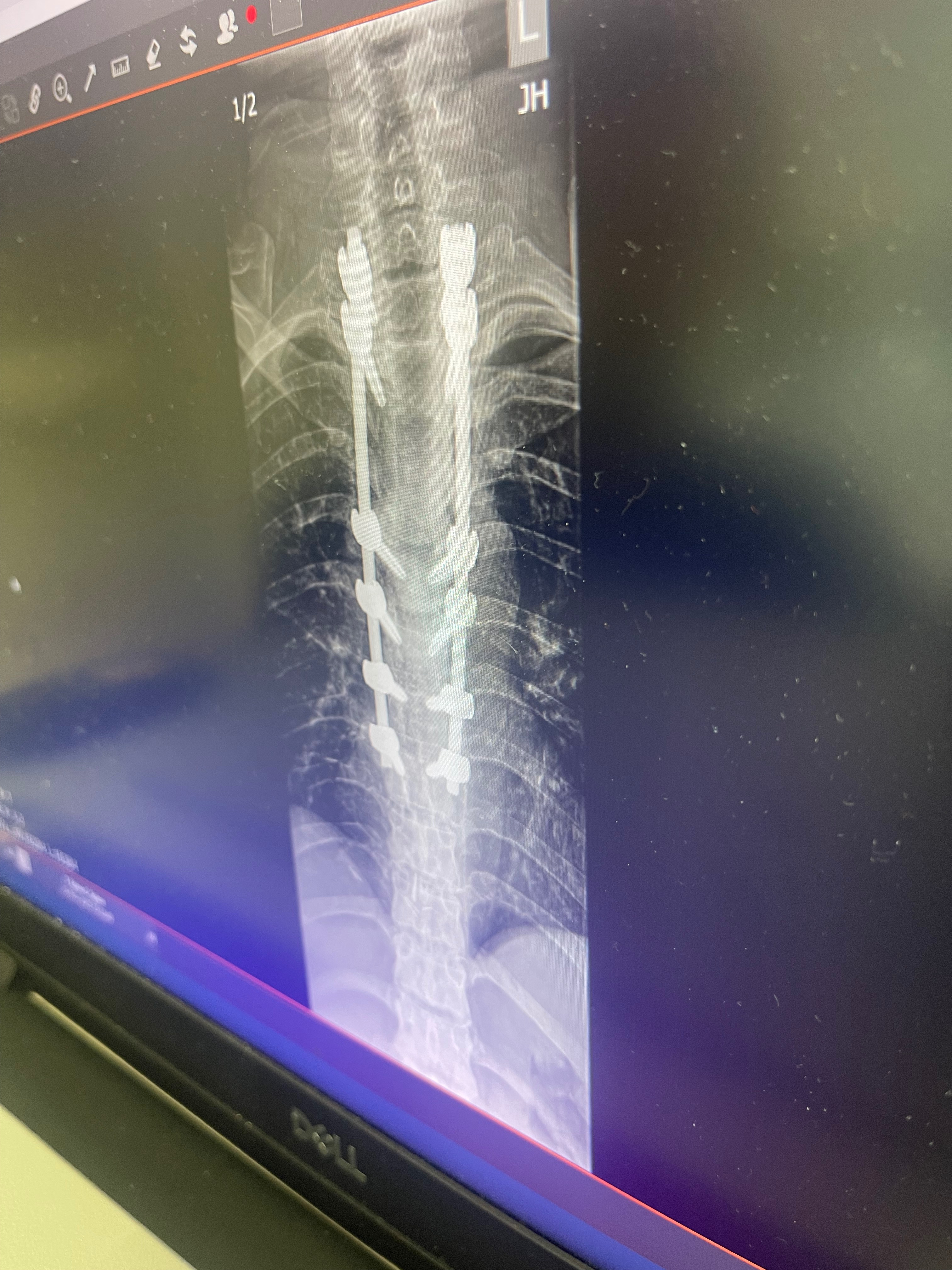 I Just need little bit help after a spine  surgery campaign photo, 5 of 6