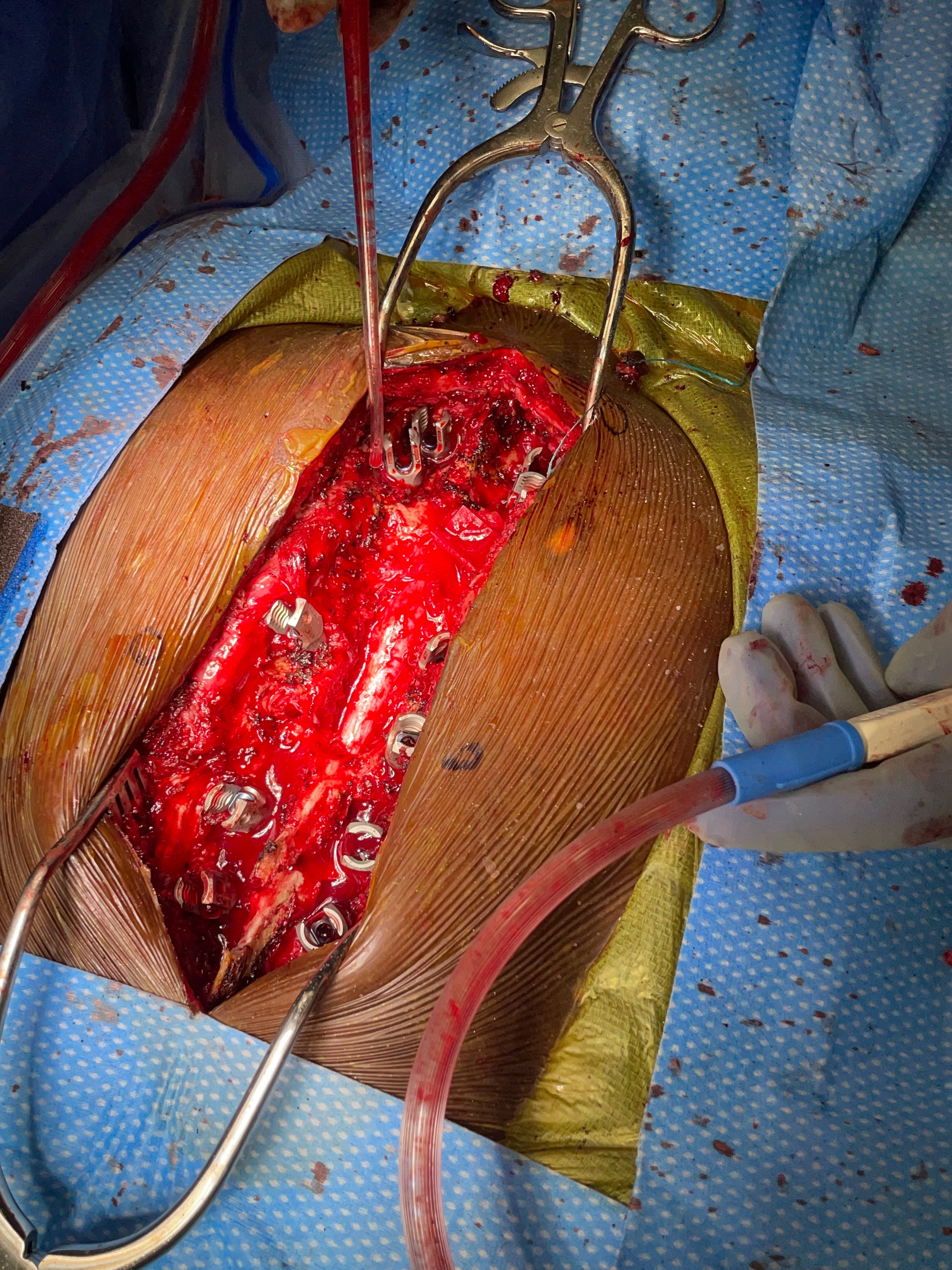 I Just need little bit help after a spine  surgery campaign photo, 2 of 6