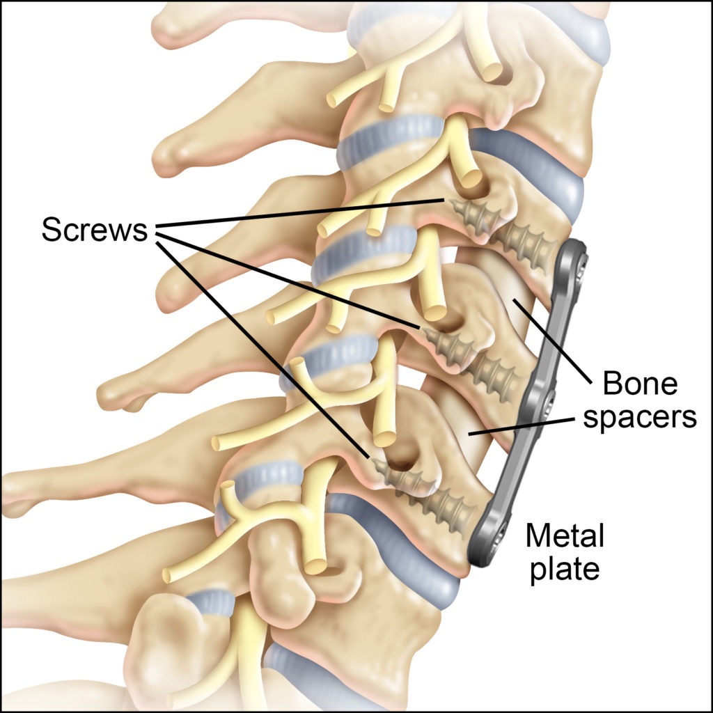 Support Mom’s Recovery After Spine Surgery campaign photo, 2 of 4