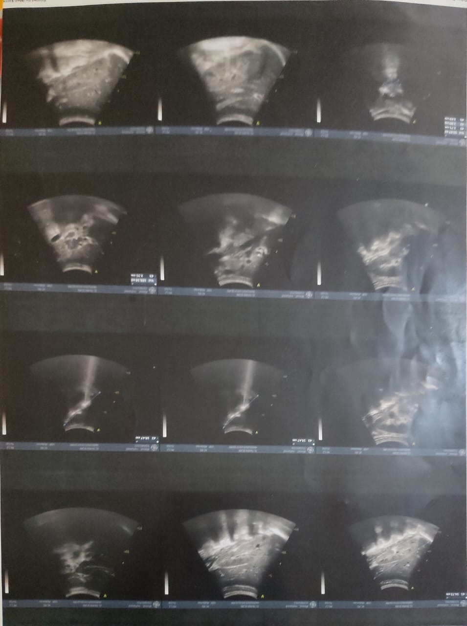 Cancer & TB Threaten Ahmed... Will We Wait Until It's Too La campaign photo, 5 of 8