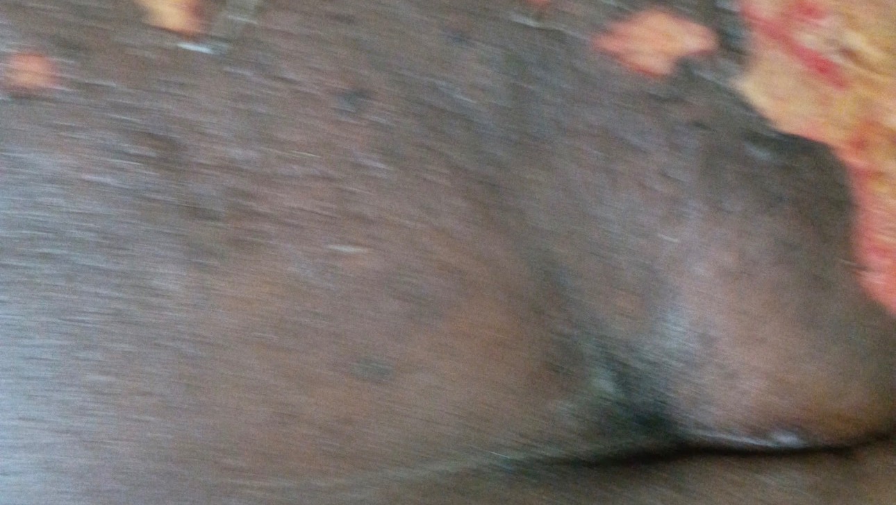 Assistance for Lipedema Treatment and Transport photo