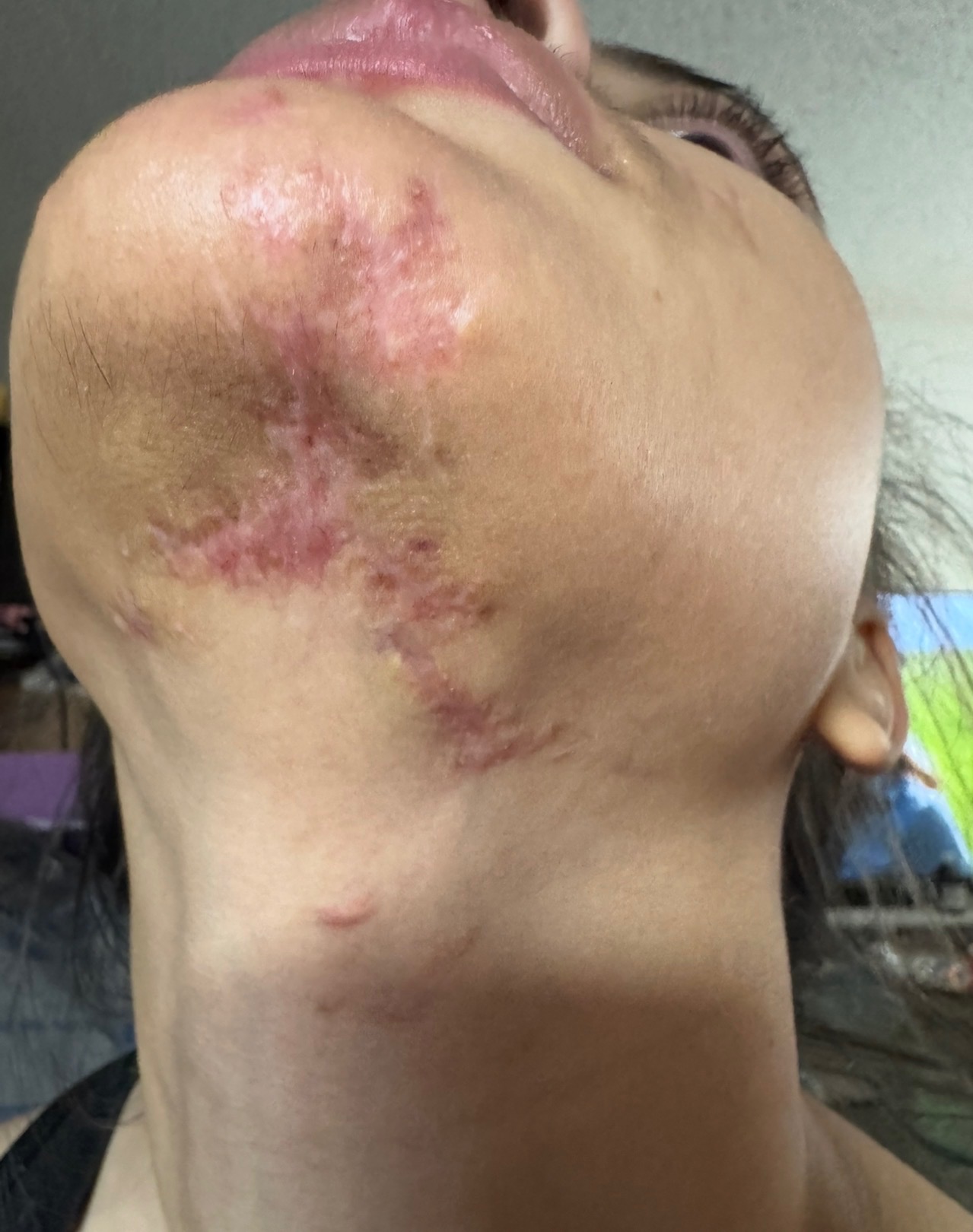 Help My Daughter Heal After Accident campaign photo, 4 of 5