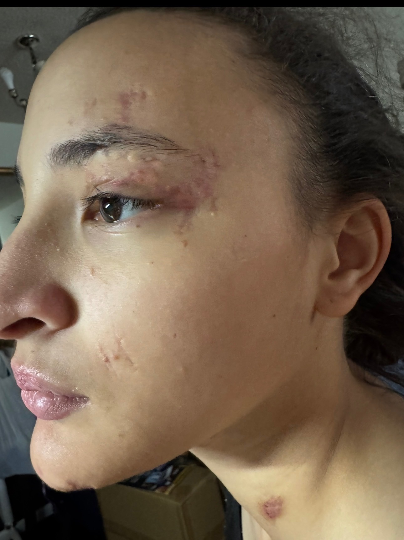 Help My Daughter Heal After Accident campaign photo, 2 of 5