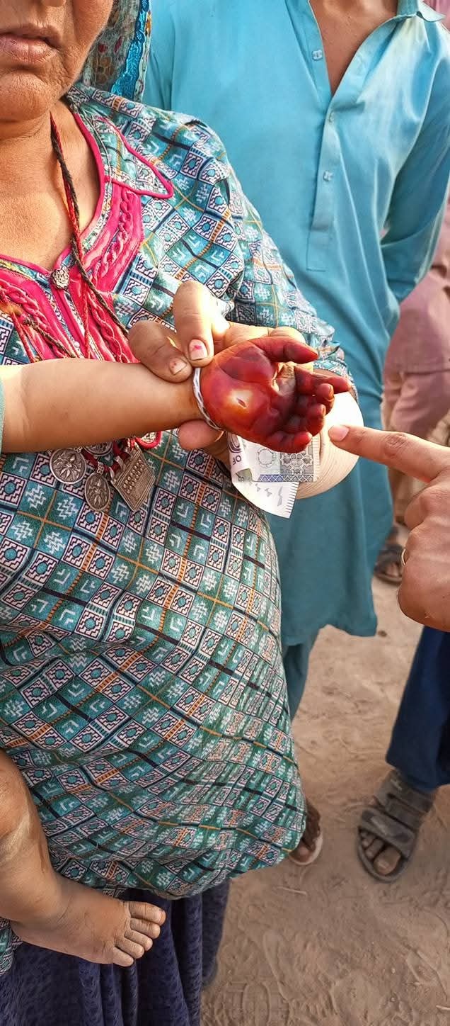 Akash Burned his Hand Very Badl He needs Immediate H campaign photo, 5 of 8