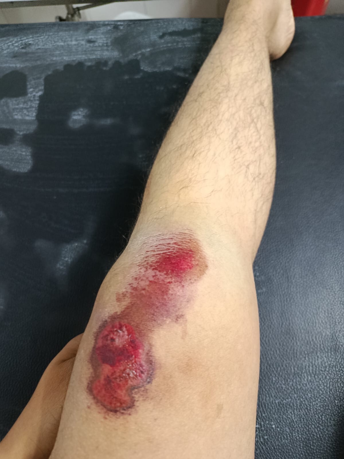 Help Emilio Cordova Get Urgent Surgery campaign photo, 2 of 6