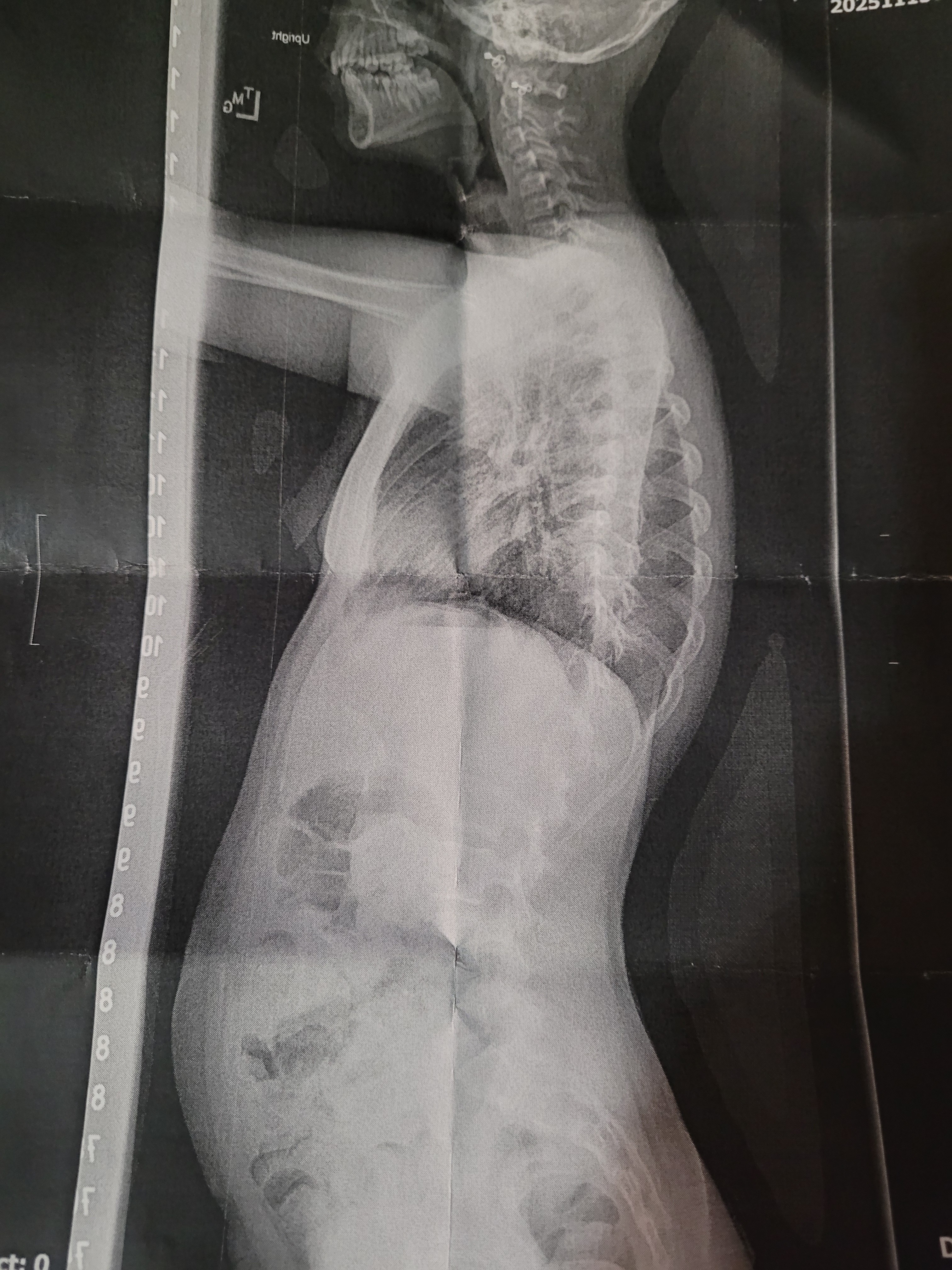 Help Emmaline Heal: Support Her Scoliosis Surgery campaign photo, 2 of 8