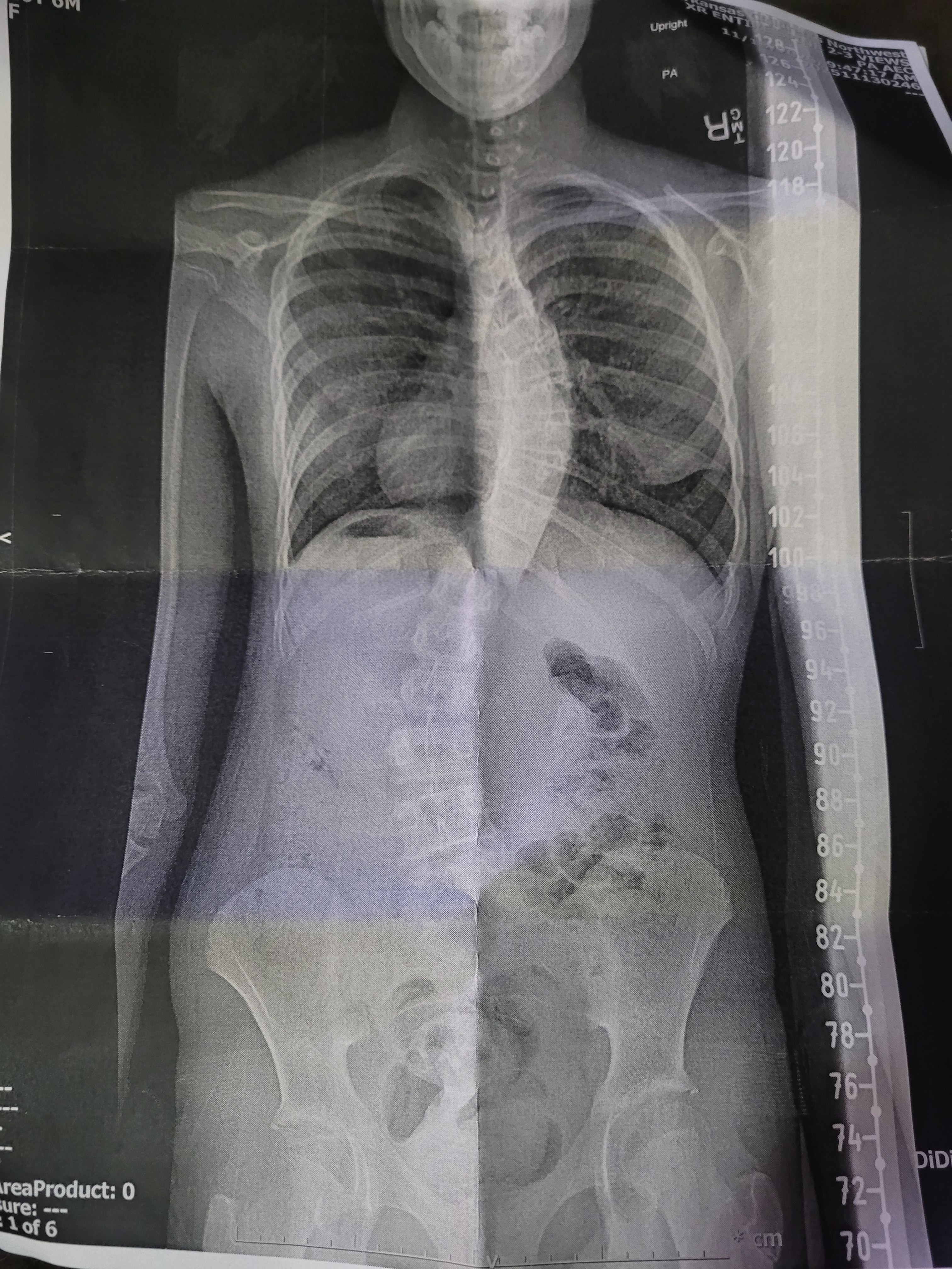 Help Emmaline Heal: Support Her Scoliosis Surgery campaign photo, 5 of 8