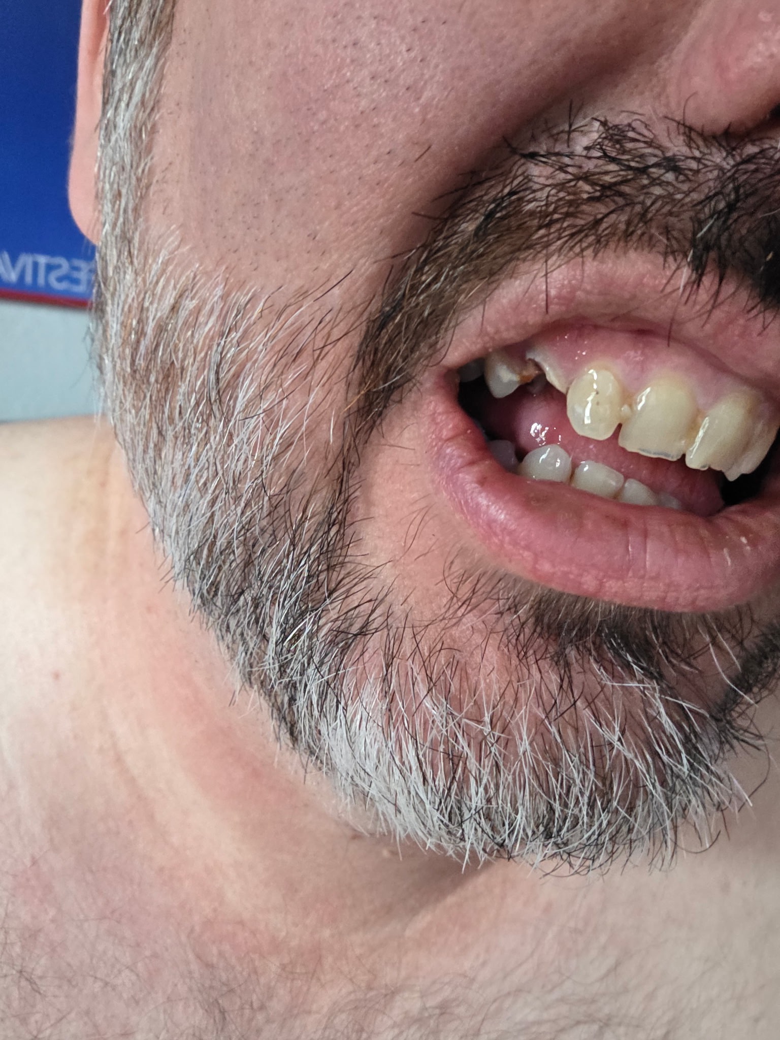 Donate for Ryan’s Dental & AS Treatment campaign photo, 2 of 4