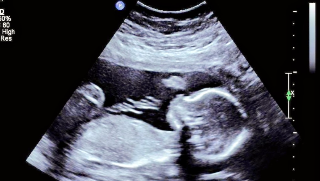 Support for Ashley's High-Risk Pregnancy & Baby photo