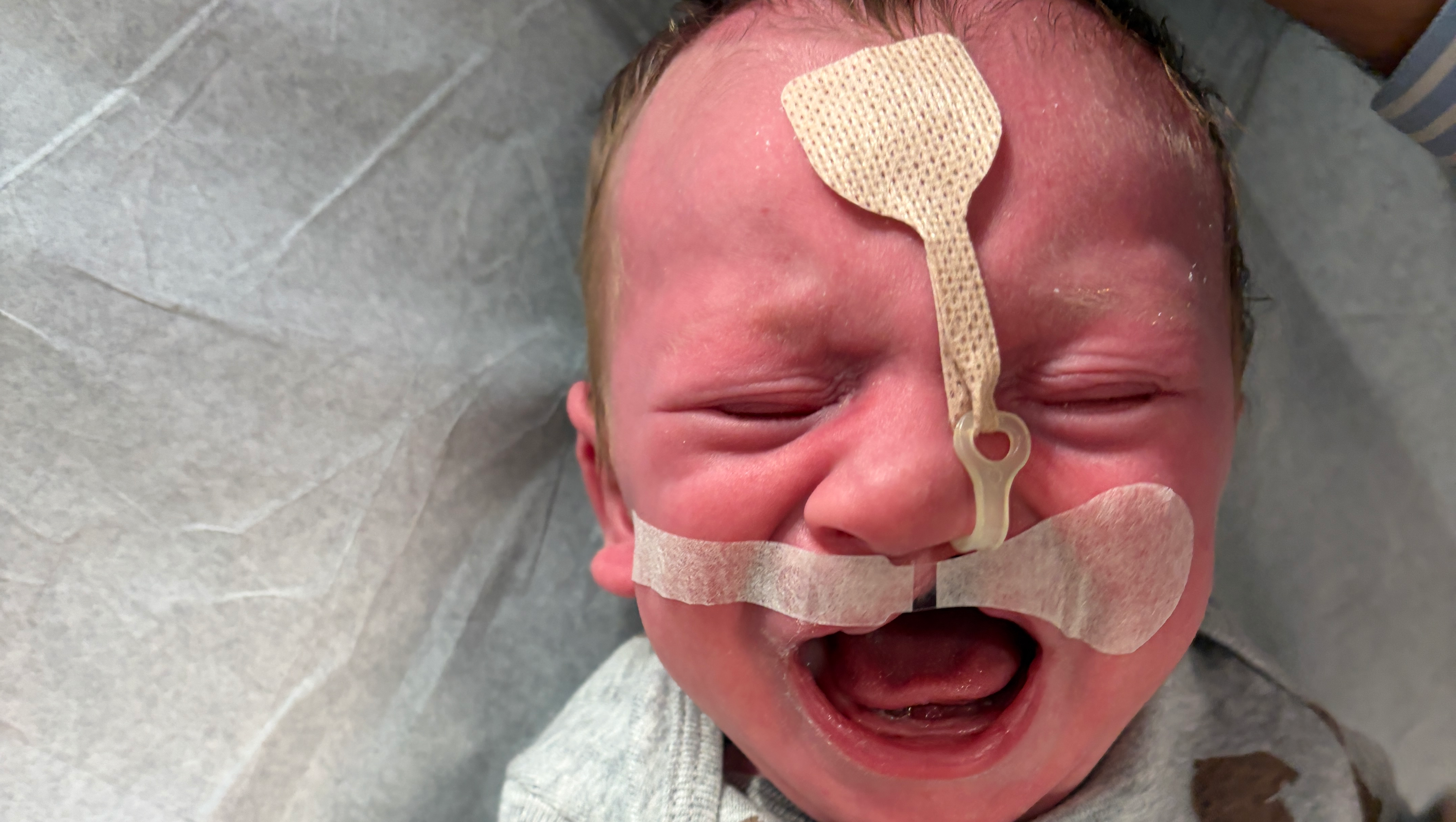 Fundraiser by David Berman : Support Baby Andrew’s Cleft Lip and Palate ...