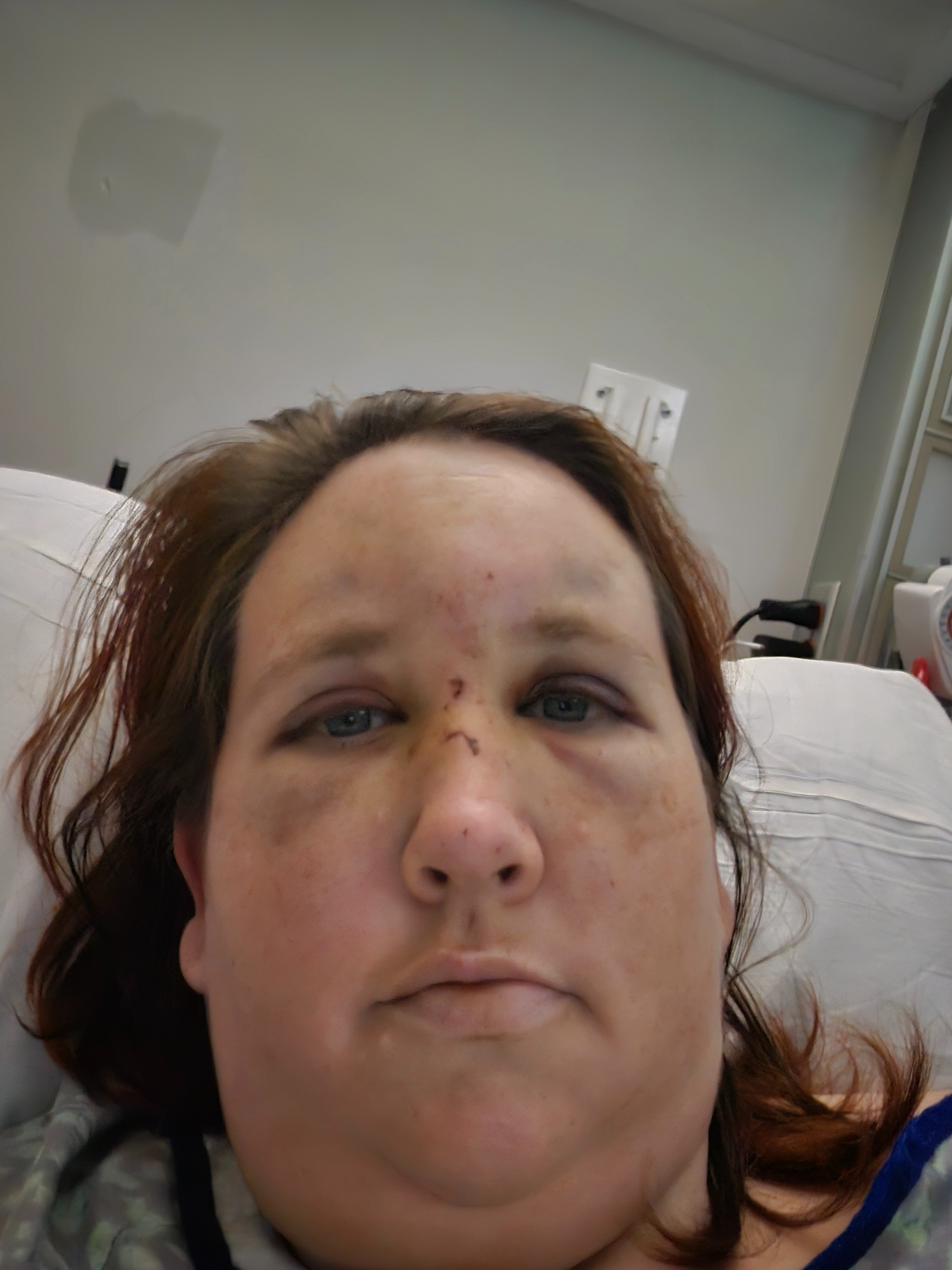 Support Corrine's Recovery After E-Bike Accident campaign photo, 2 of 8