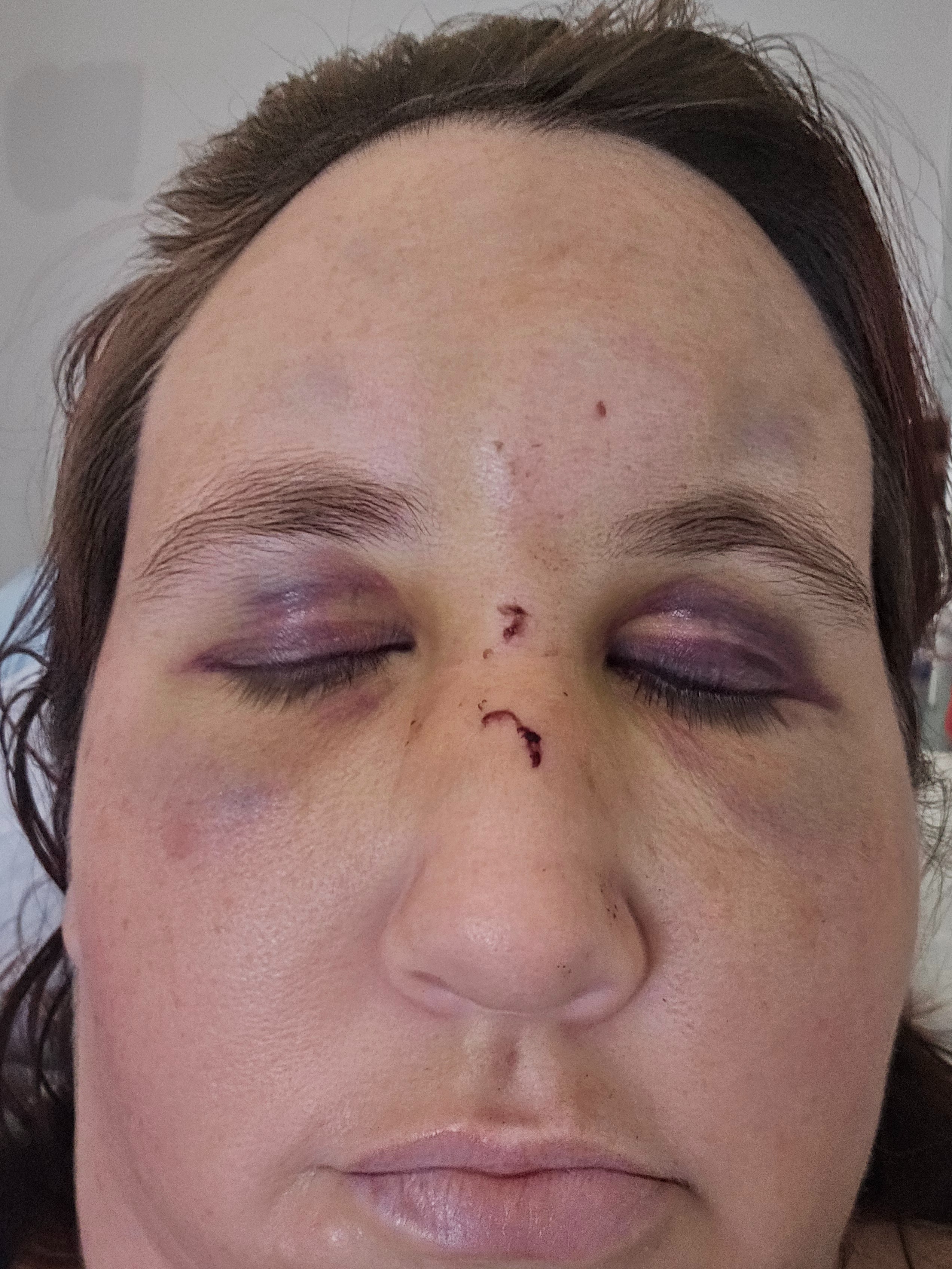 Support Corrine's Recovery After E-Bike Accident campaign photo, 6 of 8