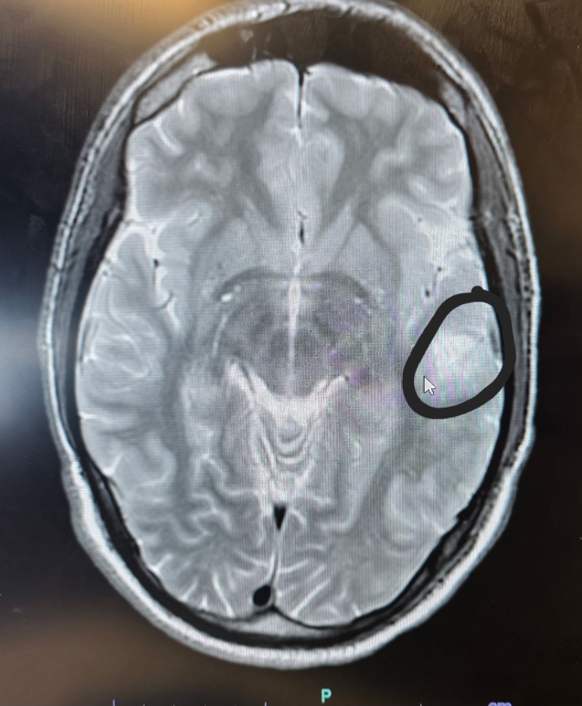 Help Corey Get Surgery for His Brain Tumor campaign photo, 2 of 4