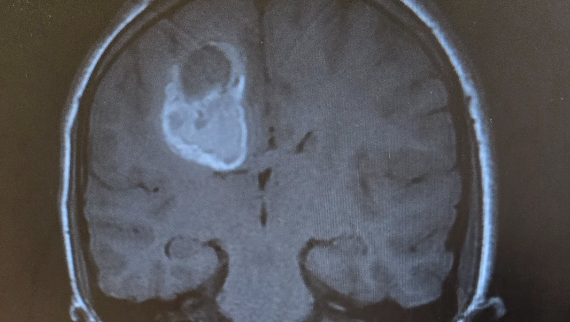 Support Mason's Brain Surgery and Recovery