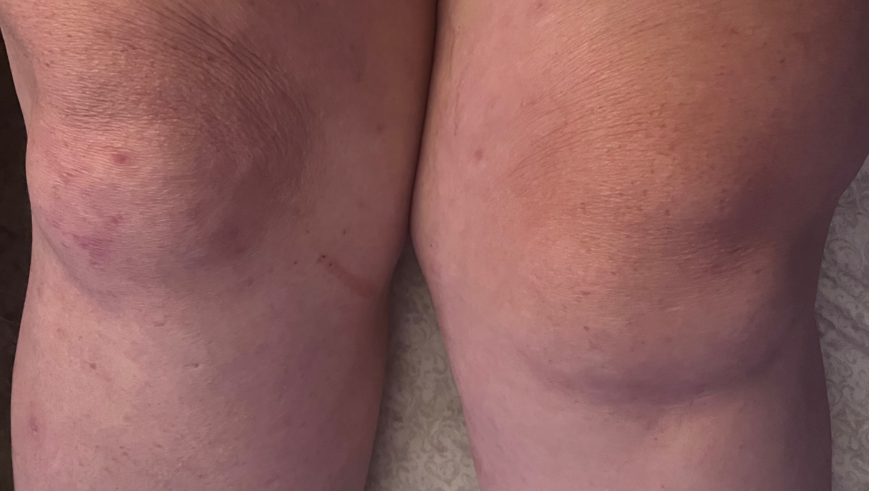 Help a Beloved Community Mom Get the Knee Surgery She Needs photo